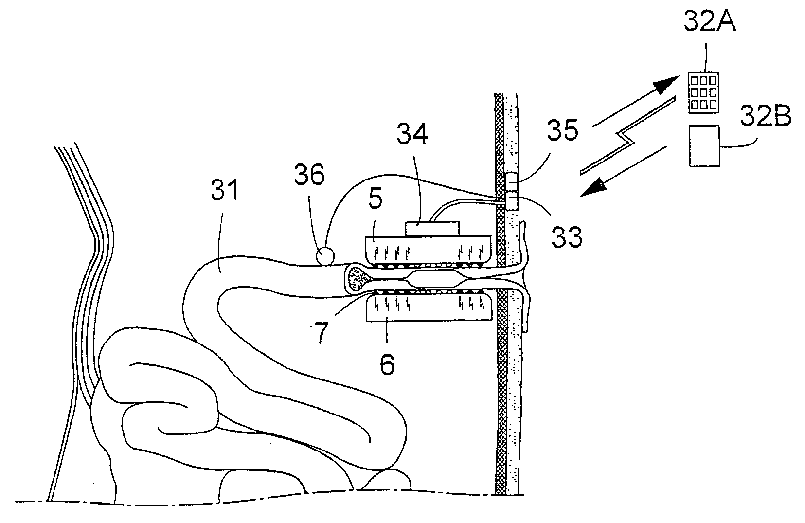 Method for controlling flow of eggs in a uterine tube