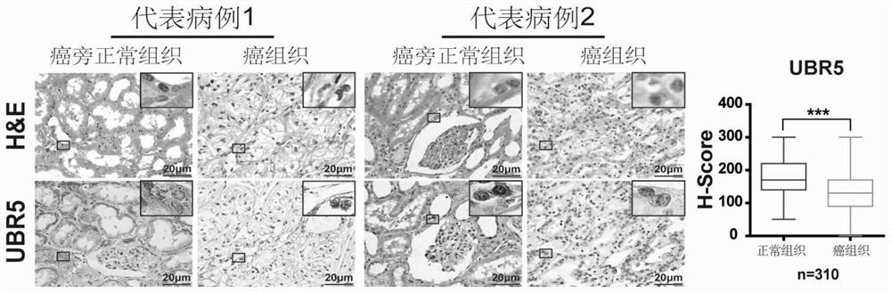 Application of E3 ubiquitination protein ligase UBR5 in preparation of tumor diagnosis or prognosis evaluation kit