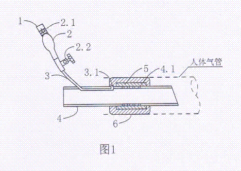 Double-layer cuff trachea cannula