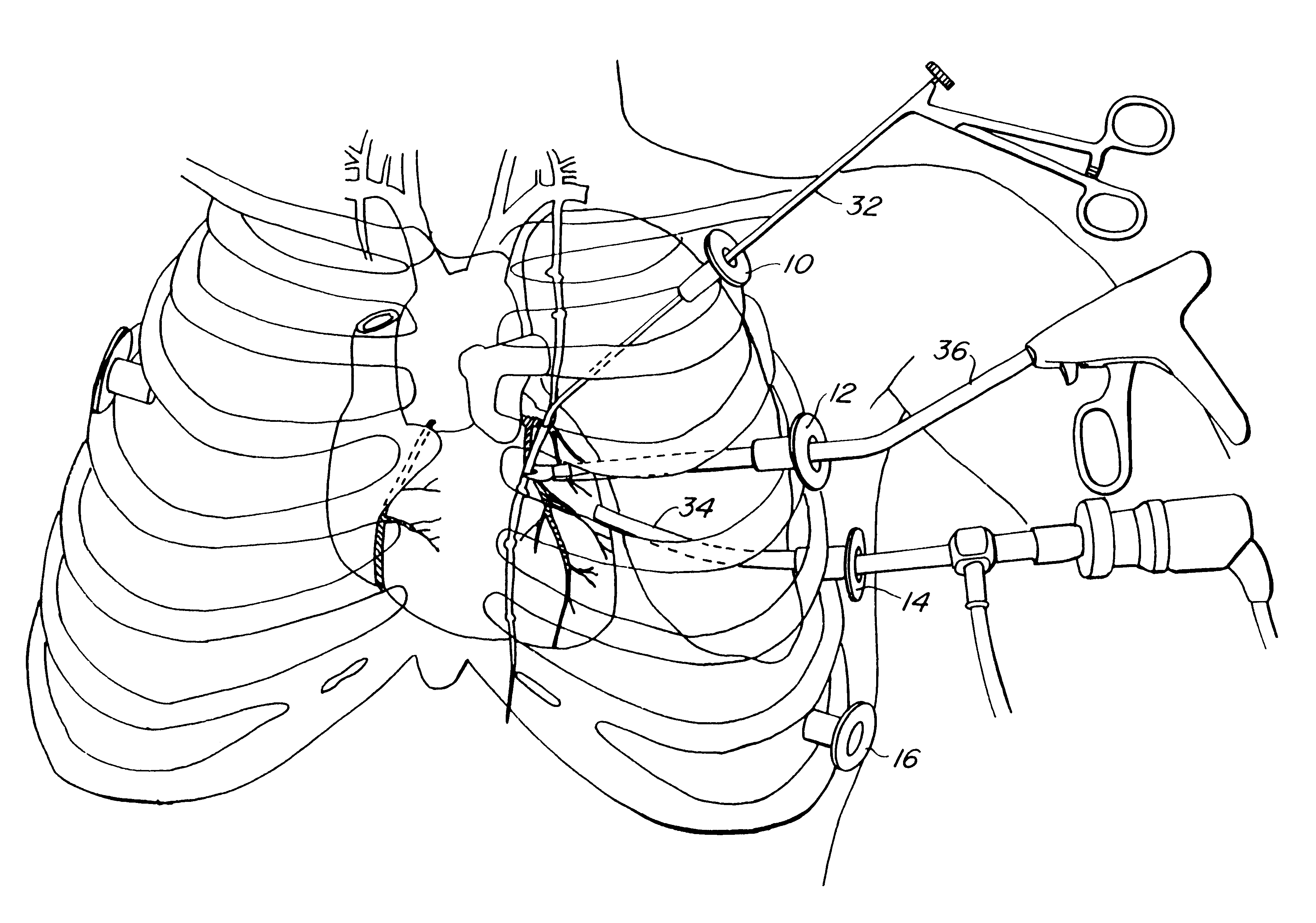 Methods and systems for performing thoracoscopic coronary bypass and other procedures