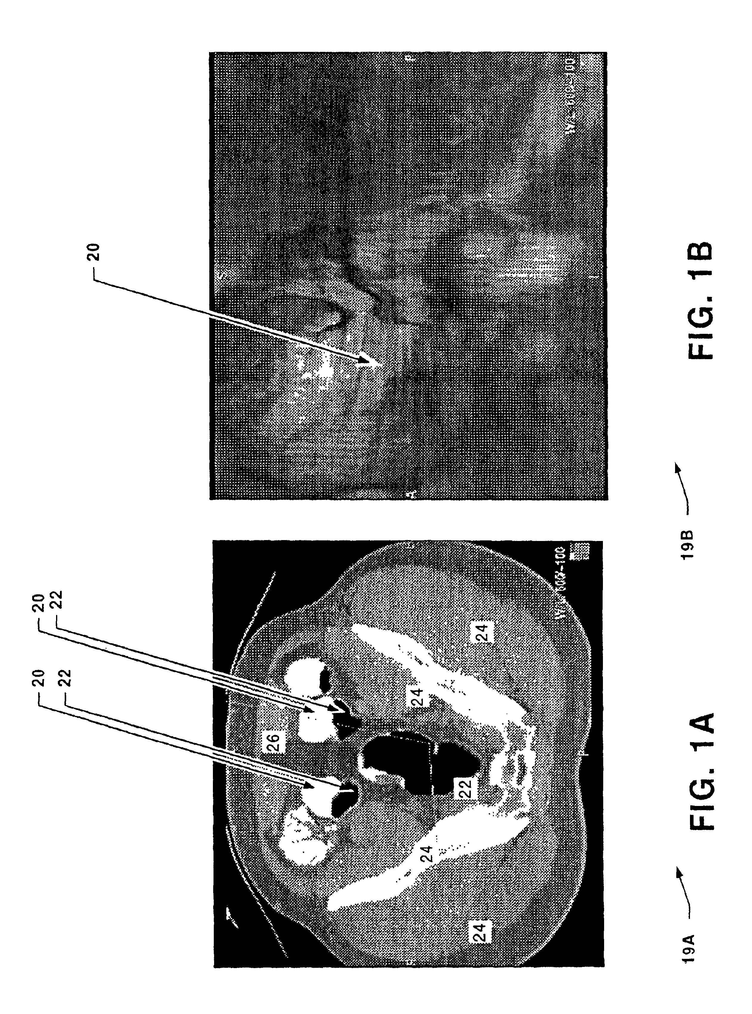 System for digital bowel subtraction and polyp detection and related techniques