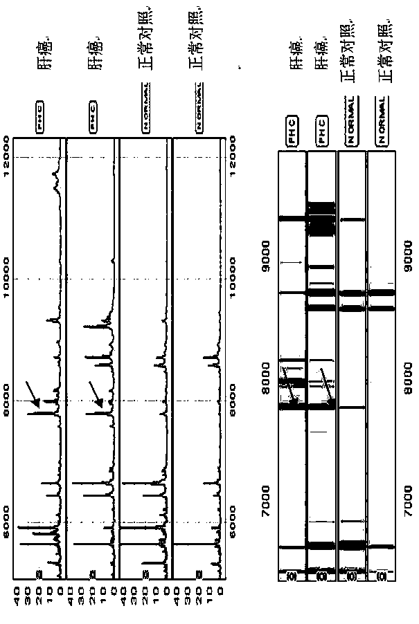 Establishment of diagnostic model for liver cancer and normal human and diagnostic model for liver cancer and chronic liver disease