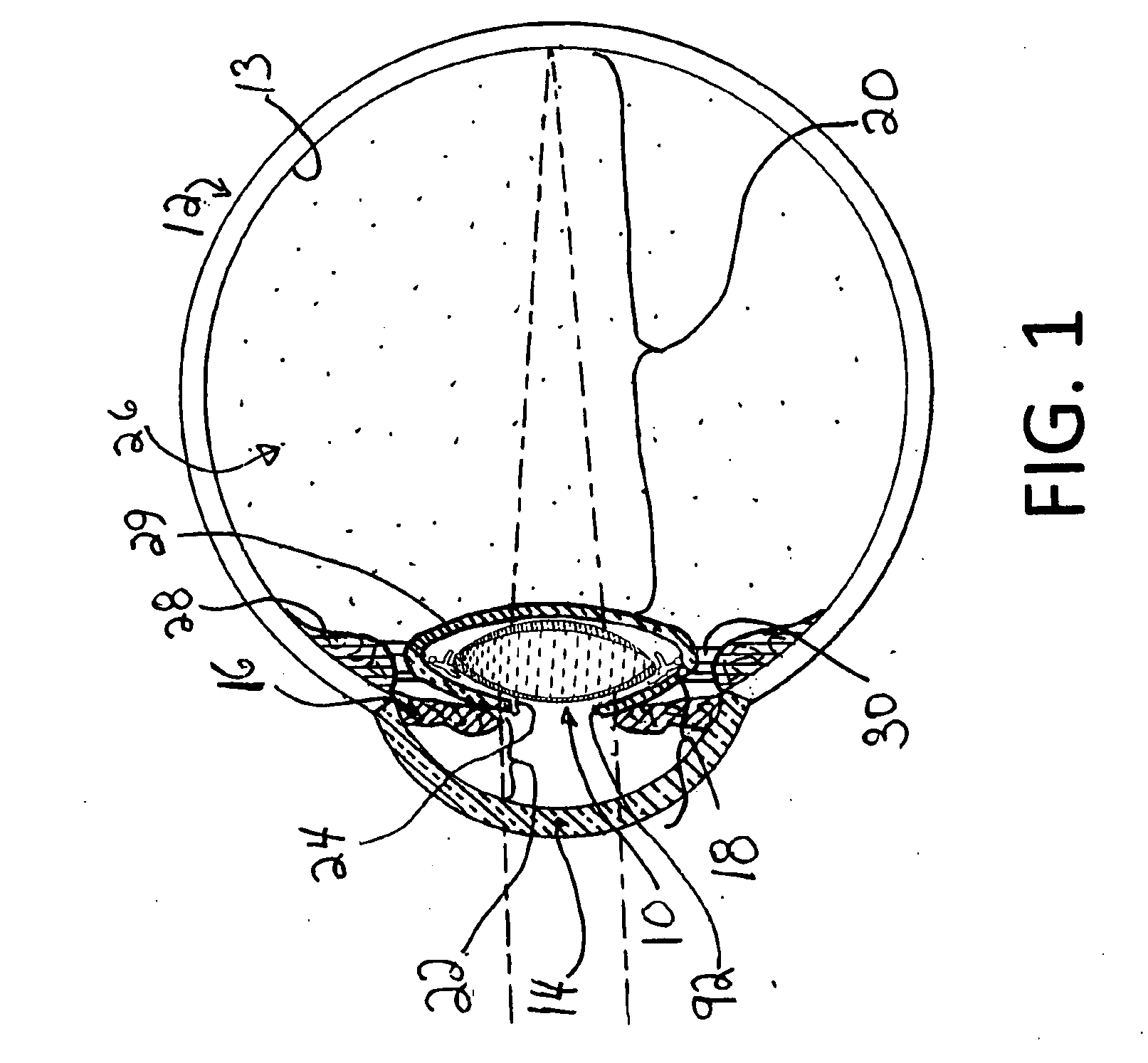 Accommodative intra-ocular lens