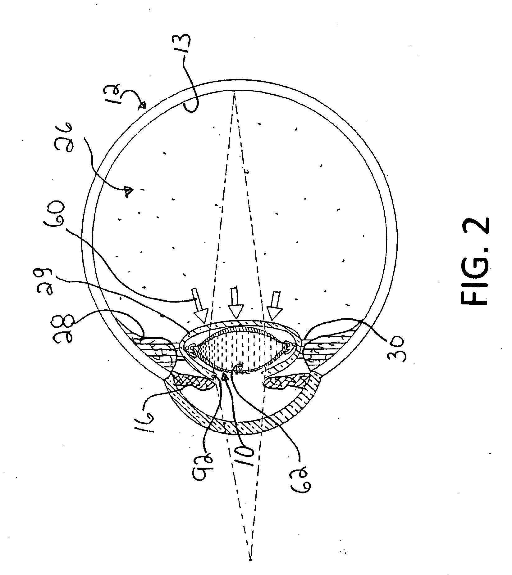 Accommodative intra-ocular lens