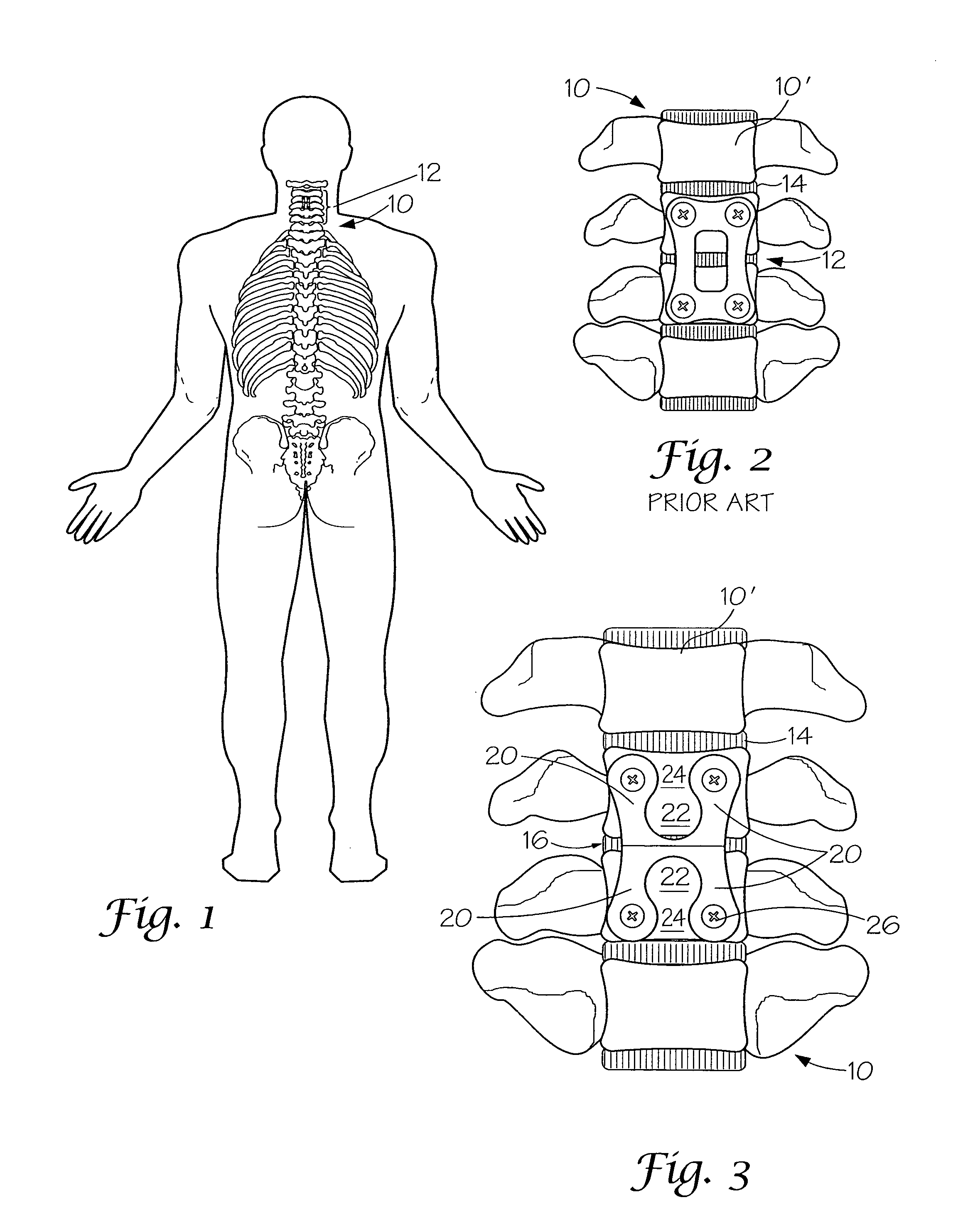 Adjacent level cervical spine plate