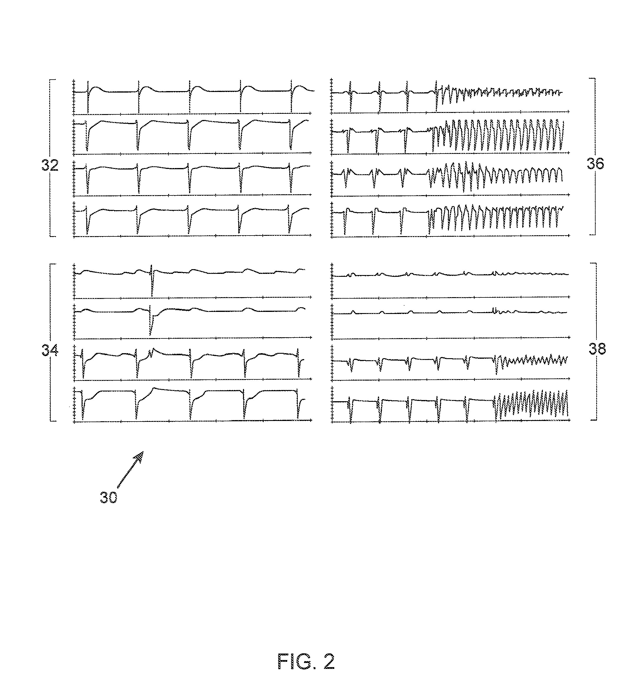 Method and associated system for the interventional treatment of atrial fibrillation