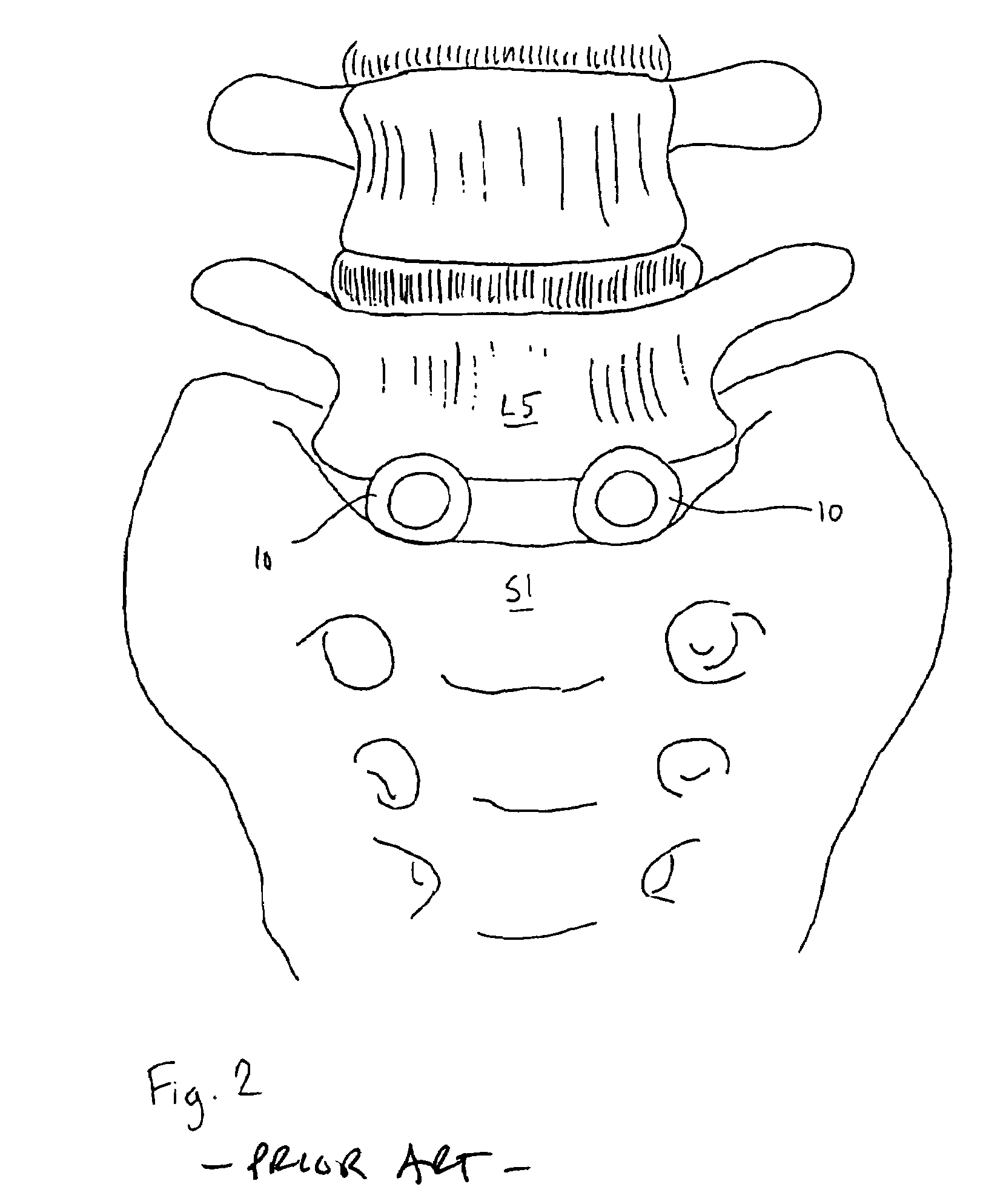 Intervertebral spacer device utilizing a spirally slotted belleville washer having radially spaced concentric grooves