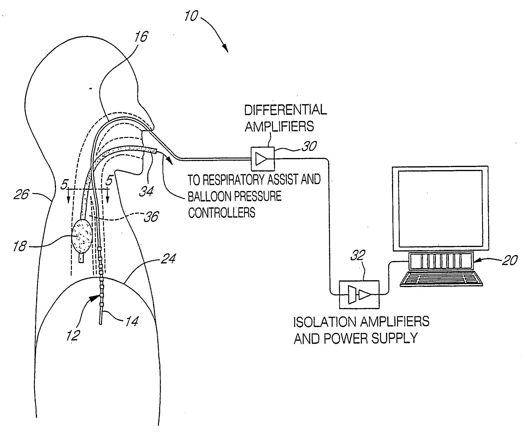 Myoelectrically activated respiratory leak sealing