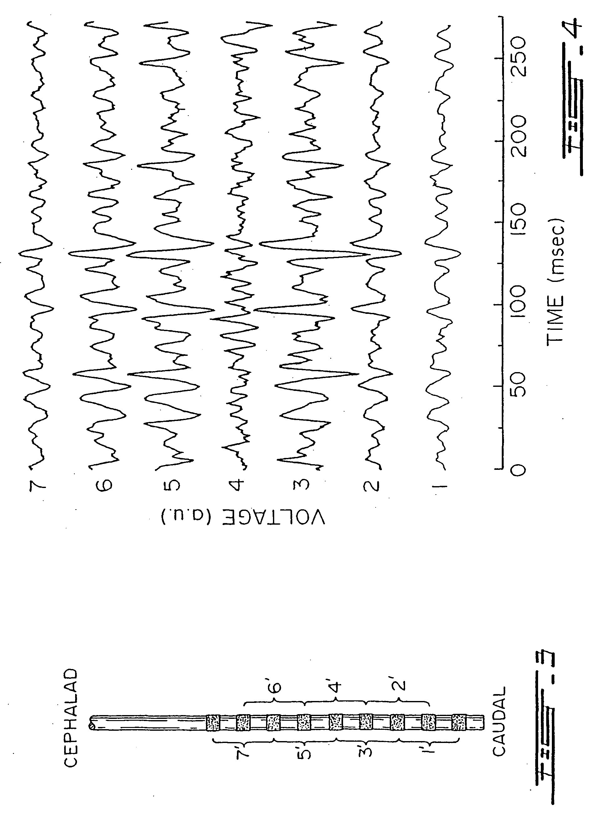 Myoelectrically activated respiratory leak sealing