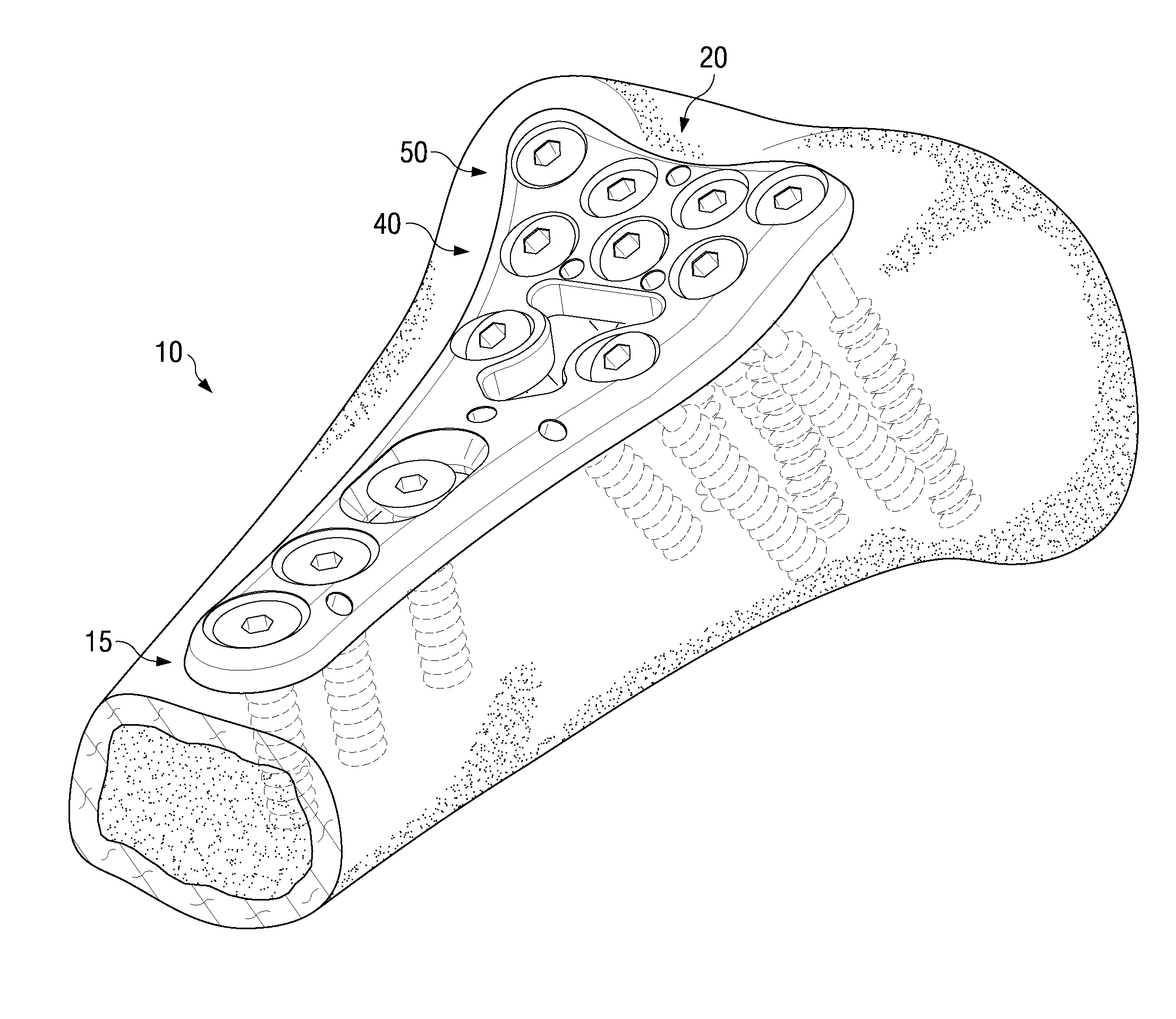 Volar plate fixation device