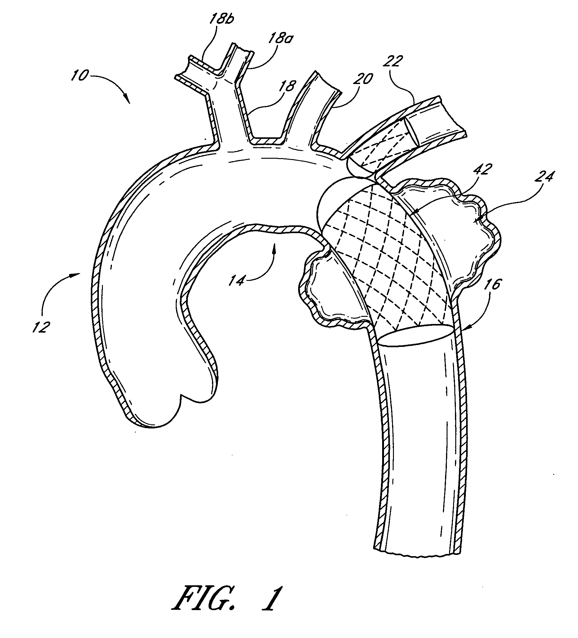 Vascular graft and deployment system