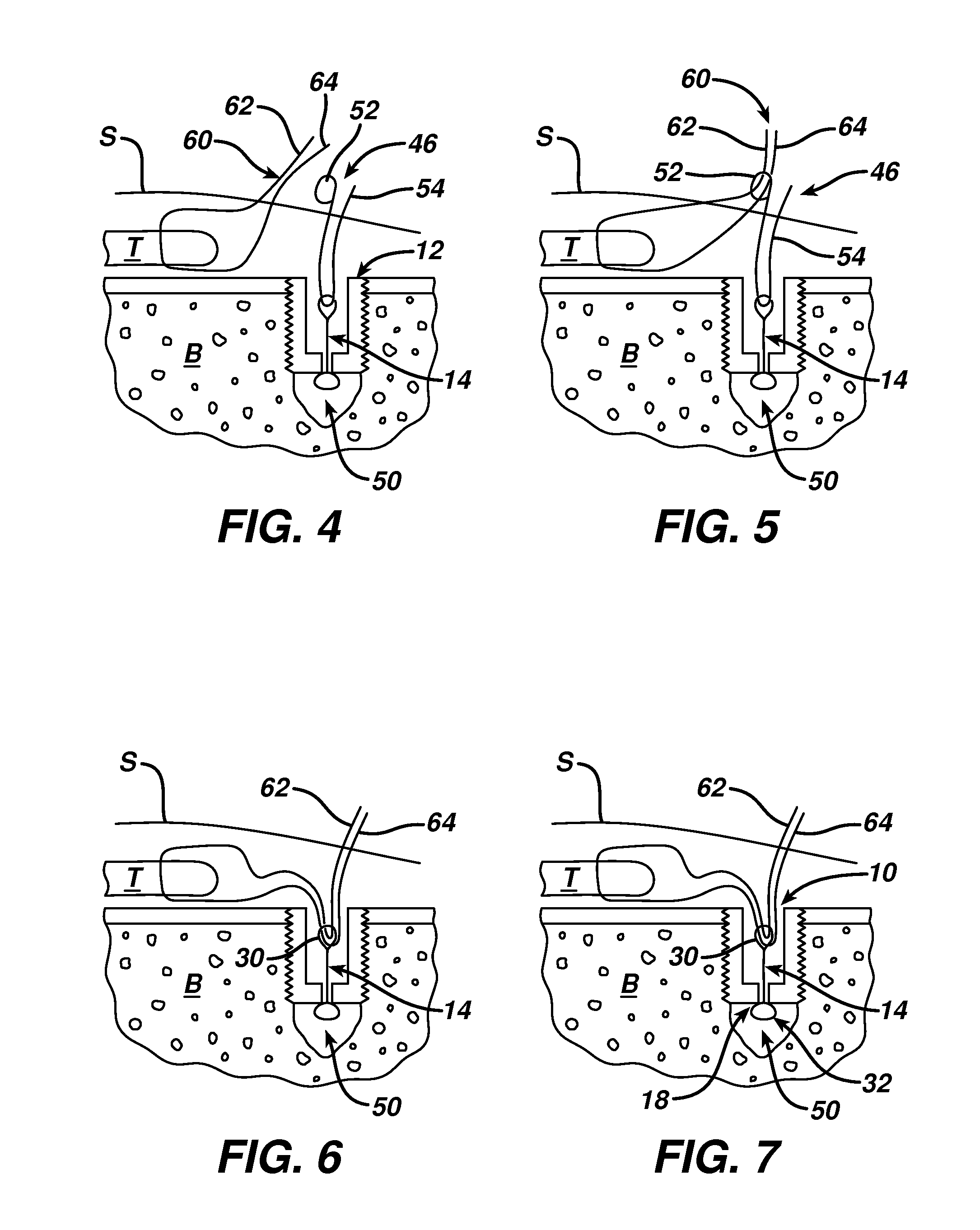 Surgical filament snare assemblies