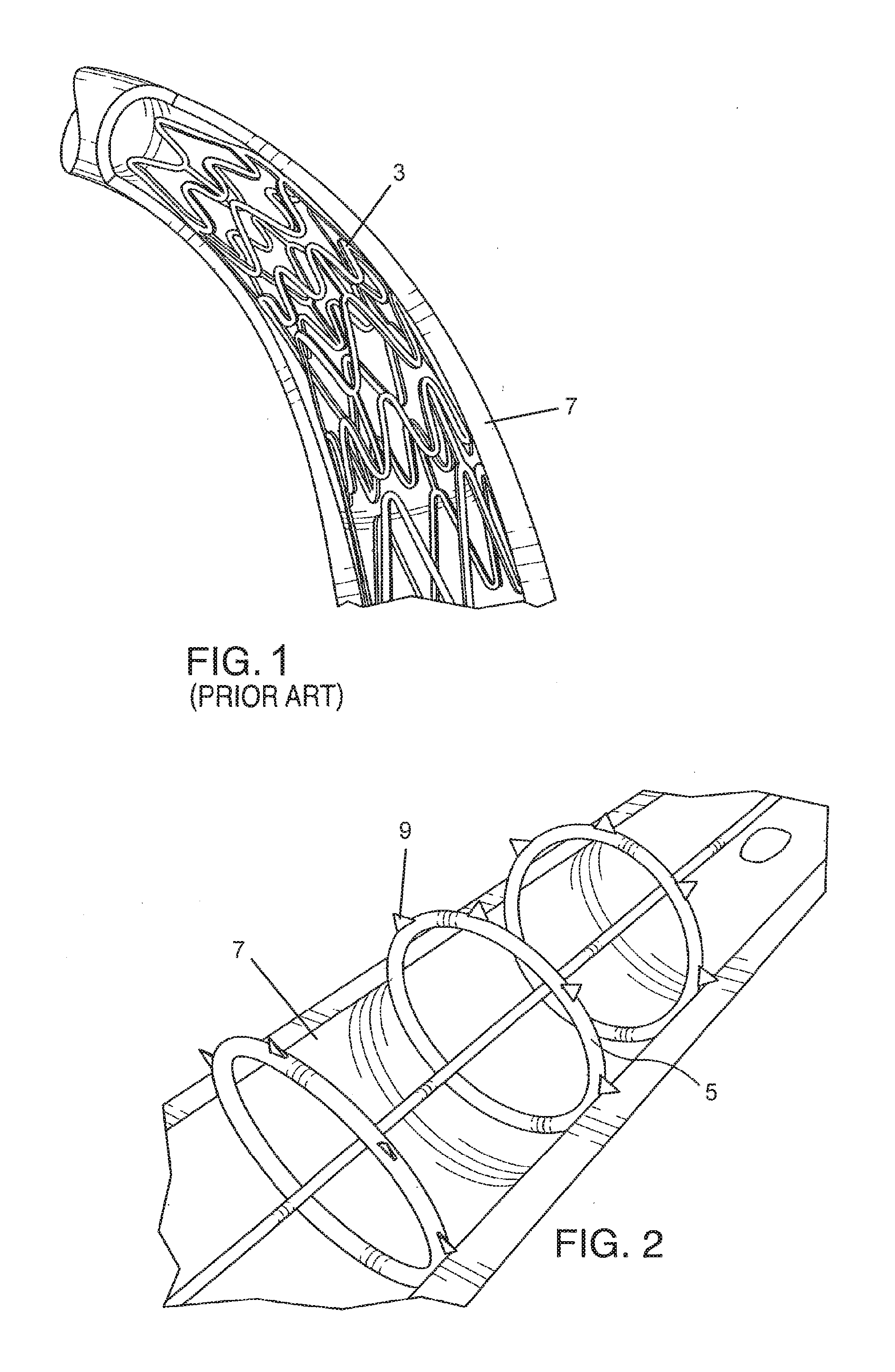 Endovascular implant