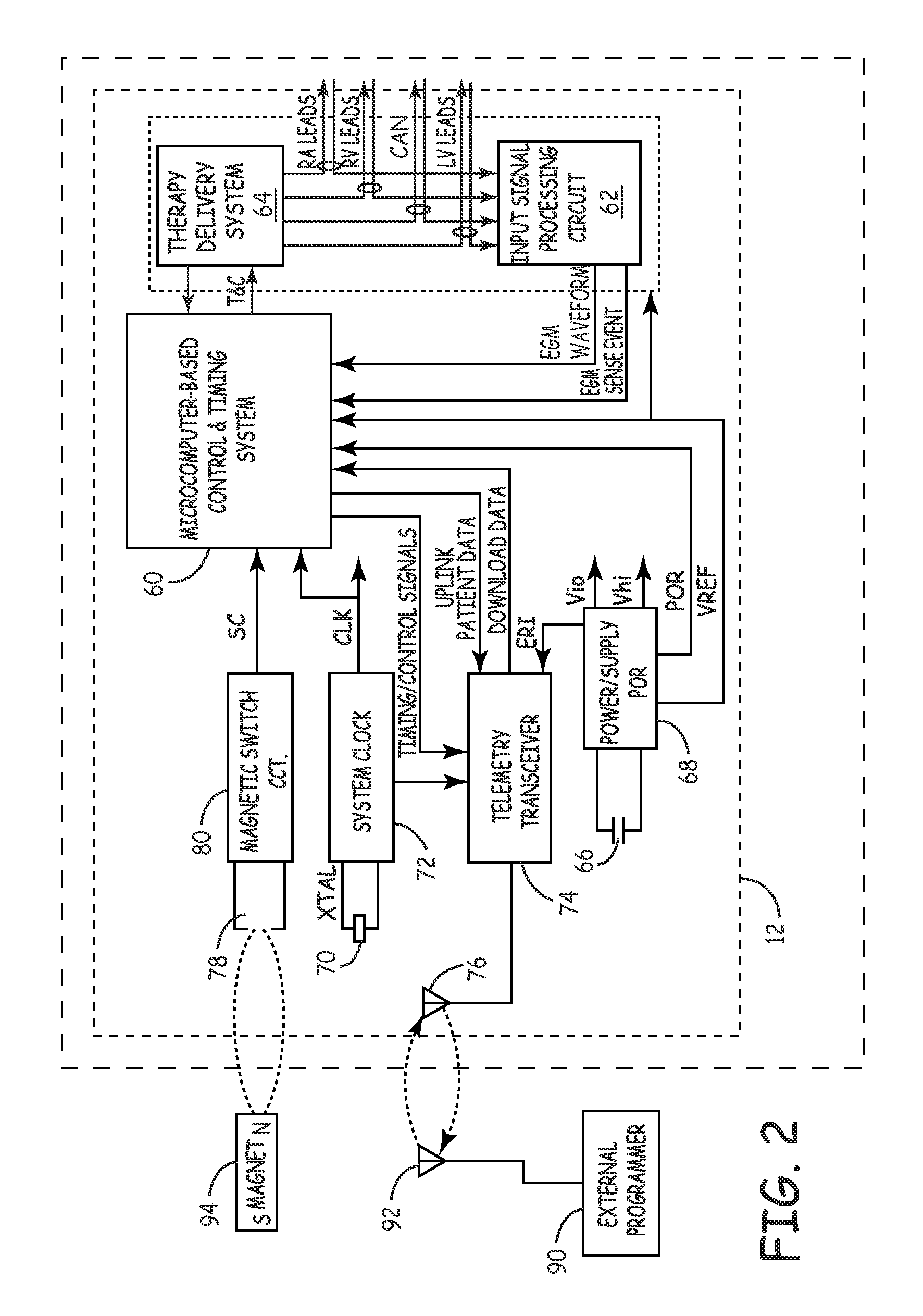 Method and apparatus for detecting left ventricular lead displacement based upon EGM change