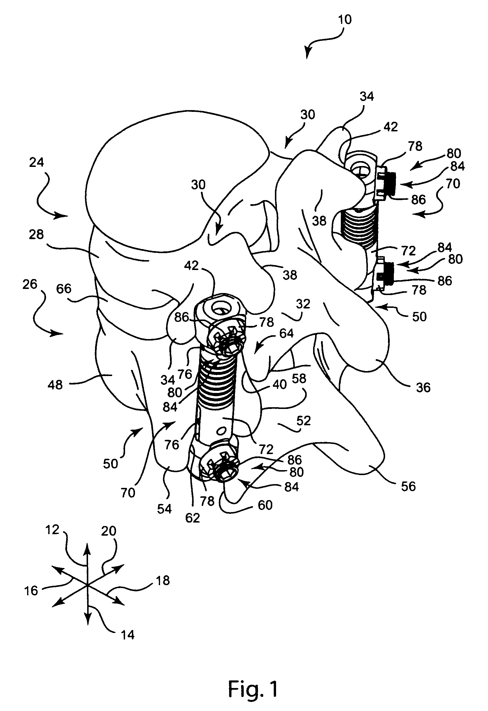 Apparatus and method for dynamic vertebral stabilization