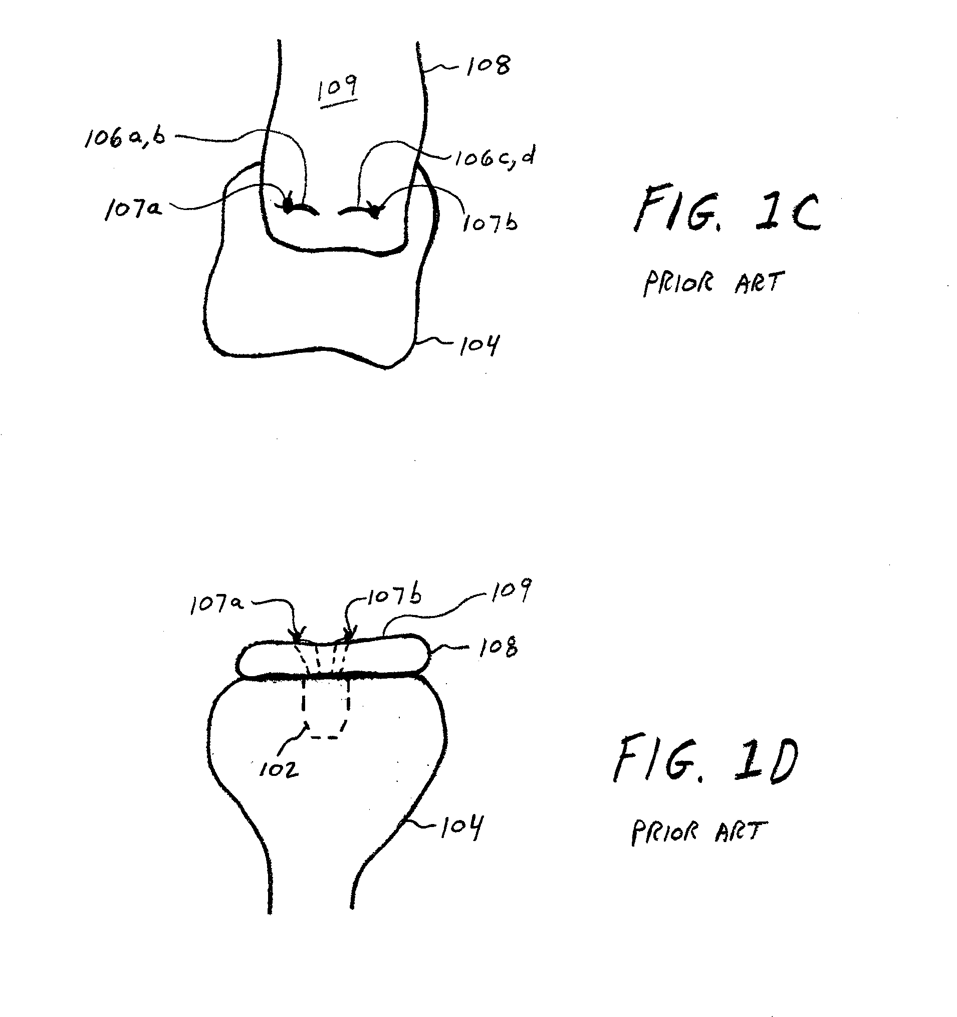 Soft Tissue Fixation Using A Looped Suture Construct