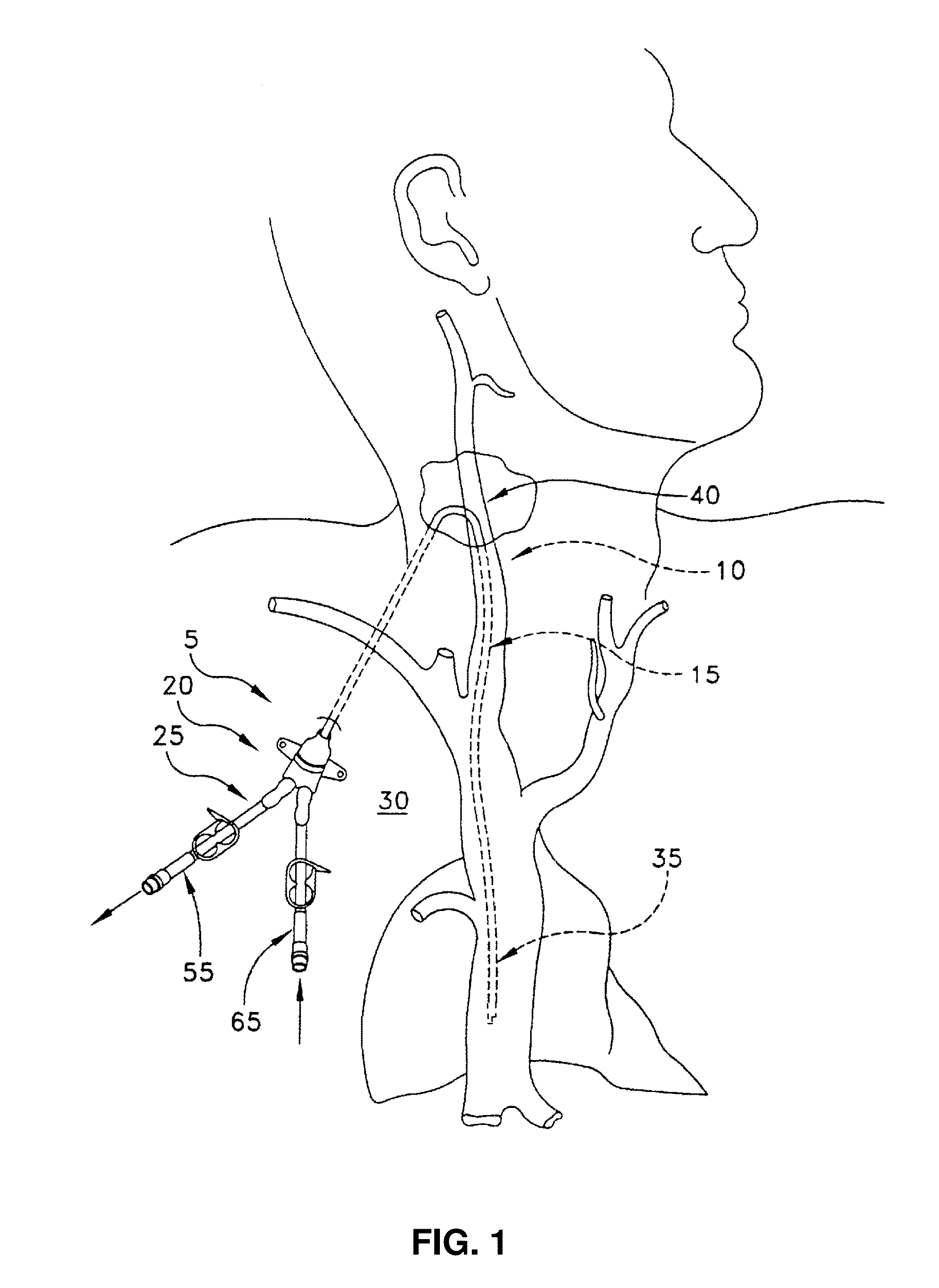 Method and apparatus for the dialysis of blood