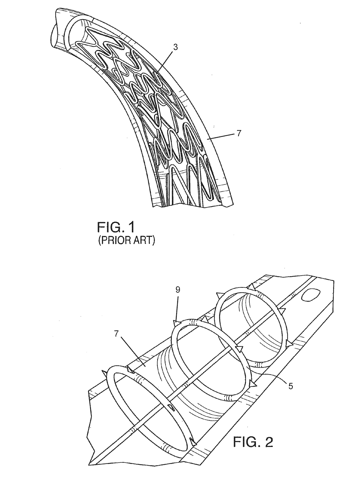 Endovascular implant