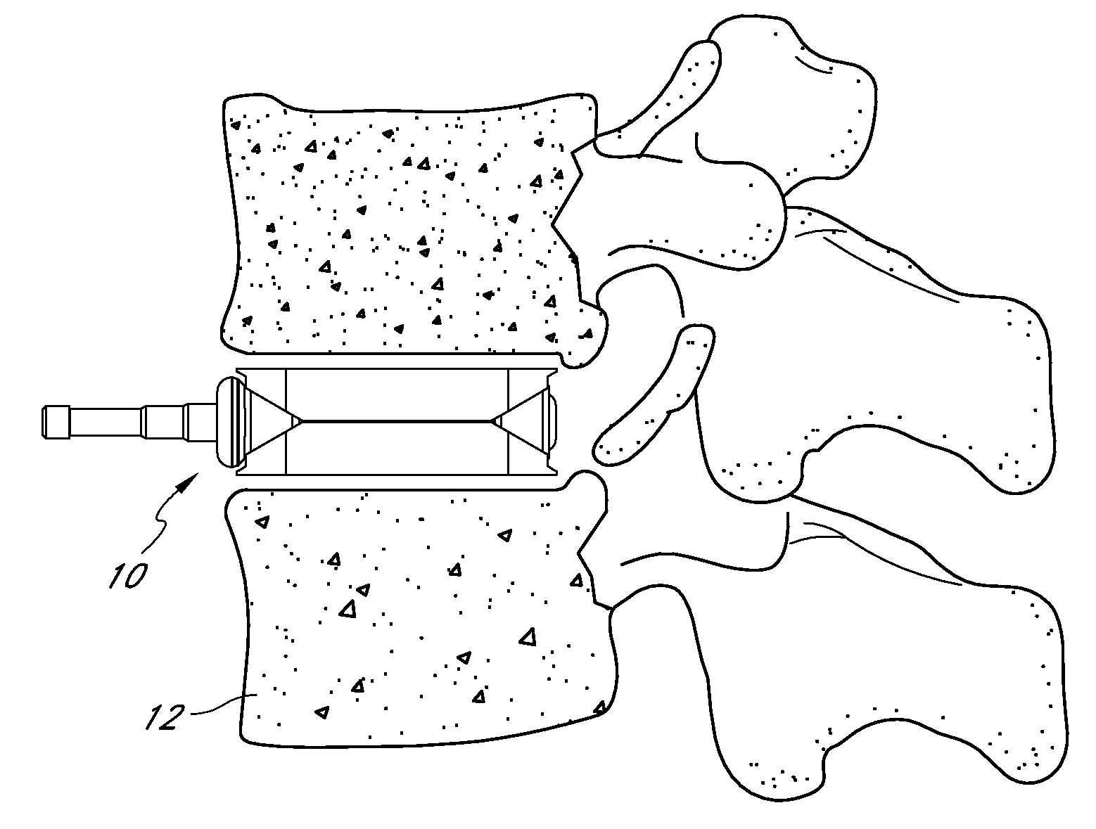 Intervertebral implant