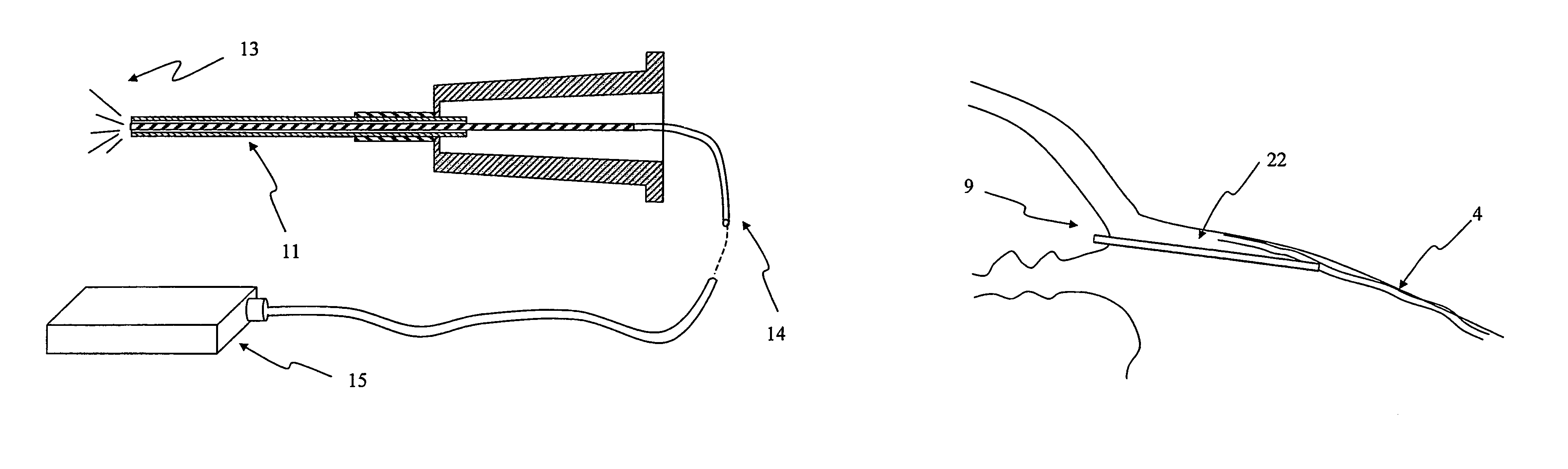 Apparatus and method for surgical bypass of aqueous humor