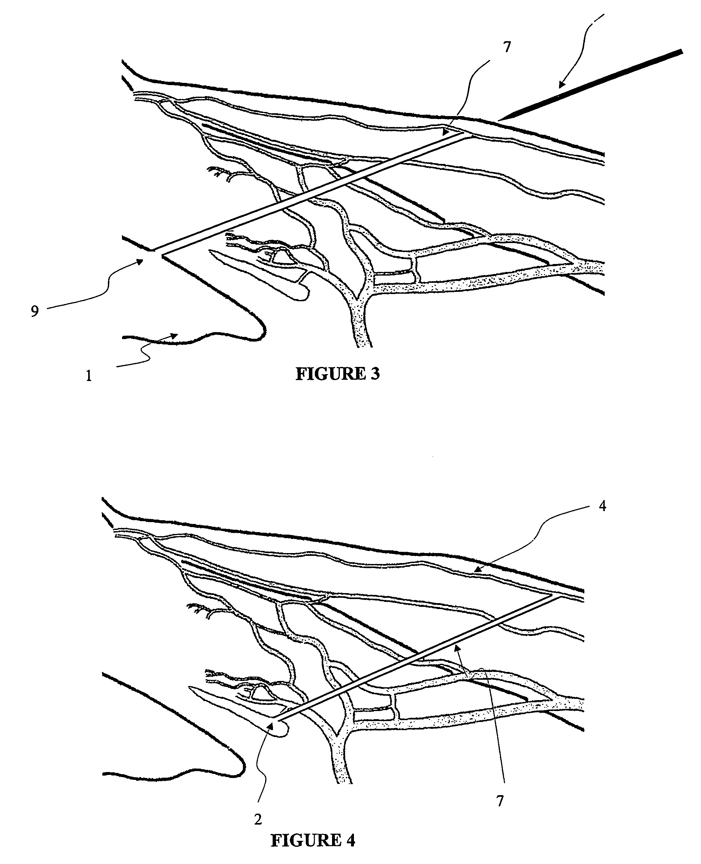 Apparatus and method for surgical bypass of aqueous humor