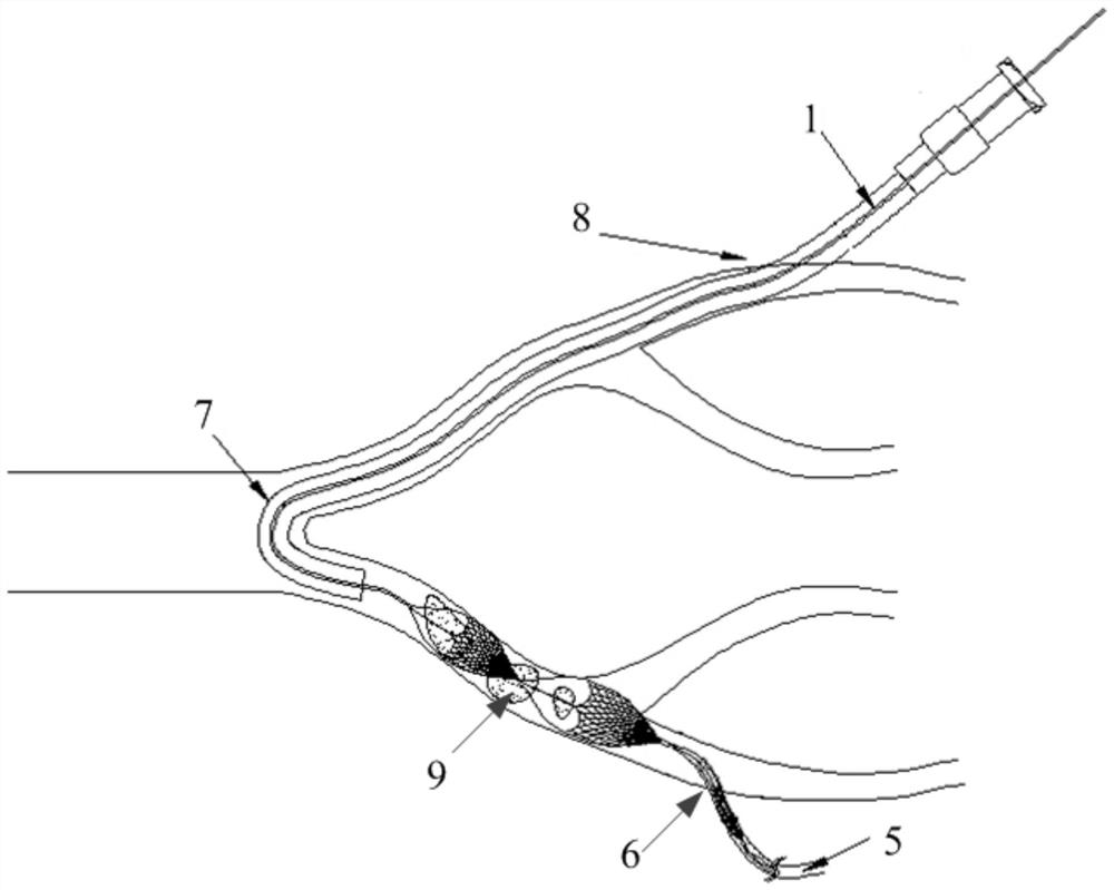 Thrombectomy