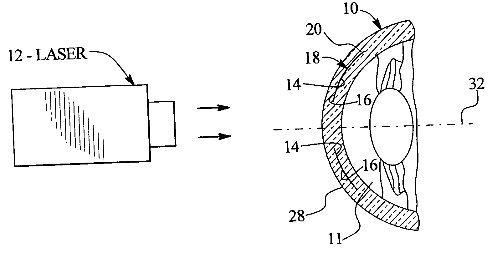 Method of treatment of refractive errors using subepithelial or intrastromal corneal inlay with bonding coating