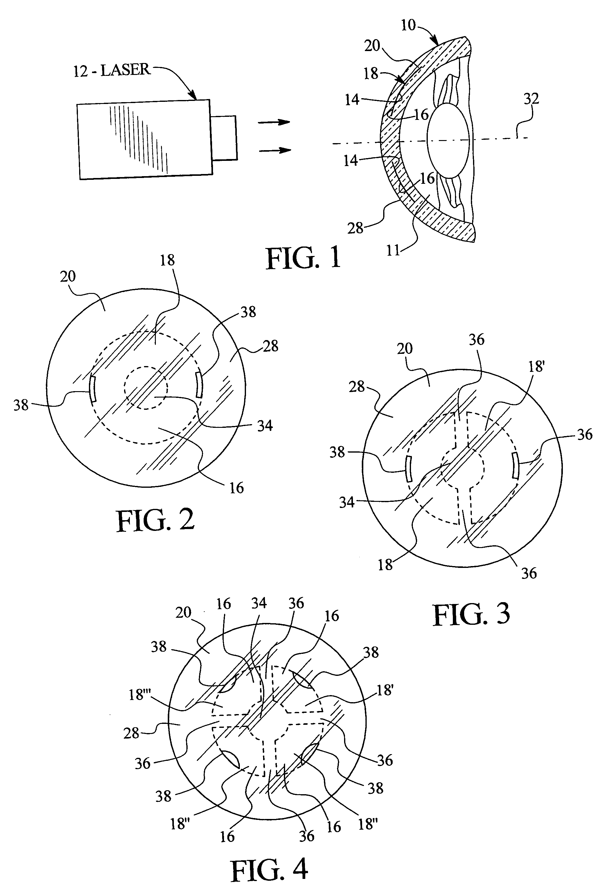 Method of treatment of refractive errors using subepithelial or intrastromal corneal inlay with bonding coating