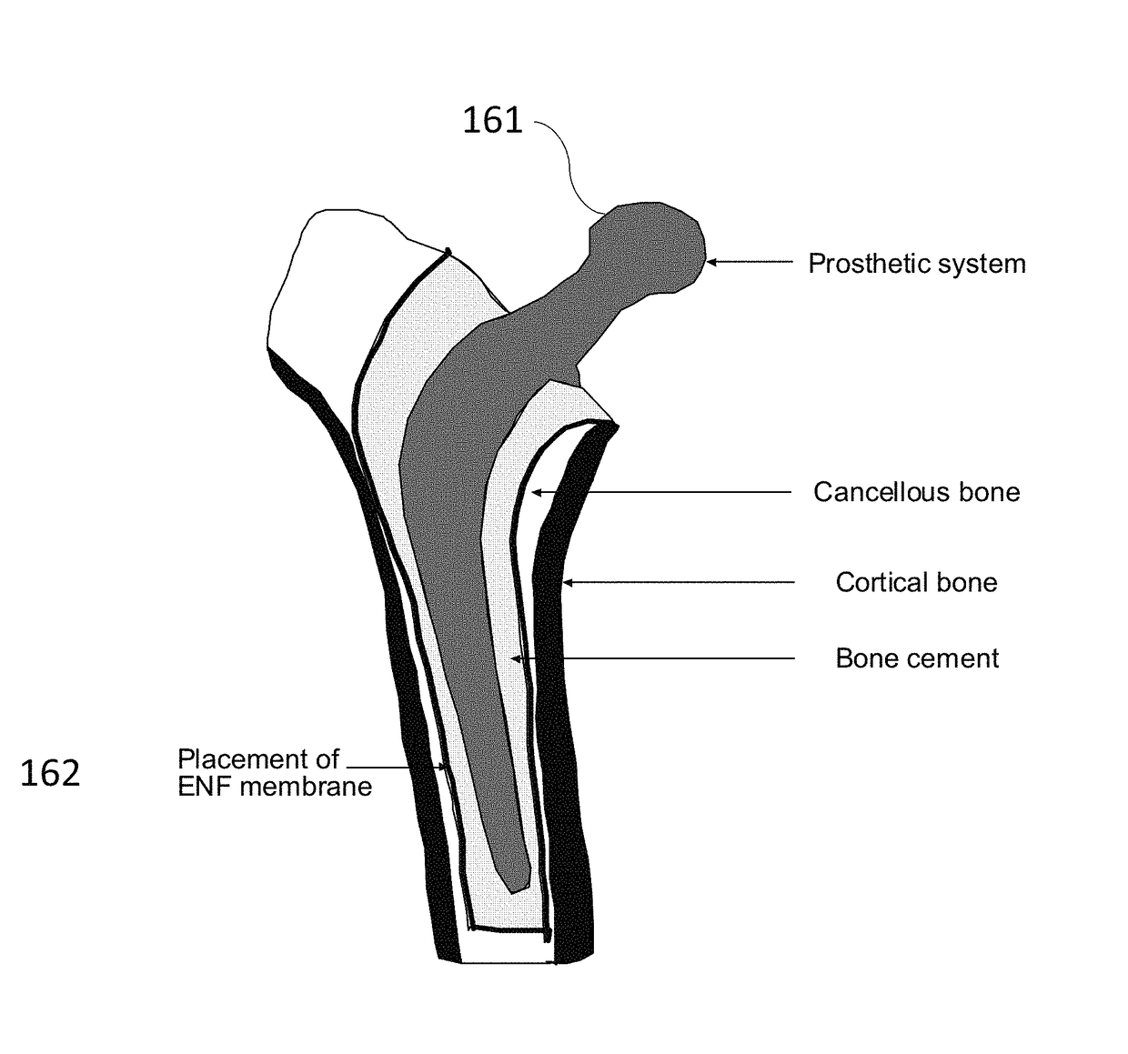 Method and apparatus to control the heterogeneous flow of bone cement and improve osseointegration of cemented implant