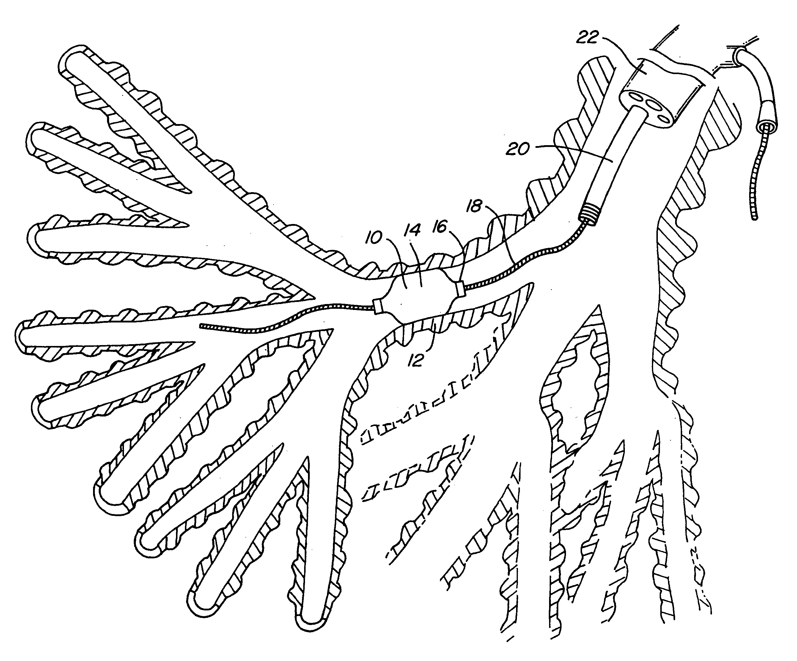 Intra-bronchial lung volume reduction system