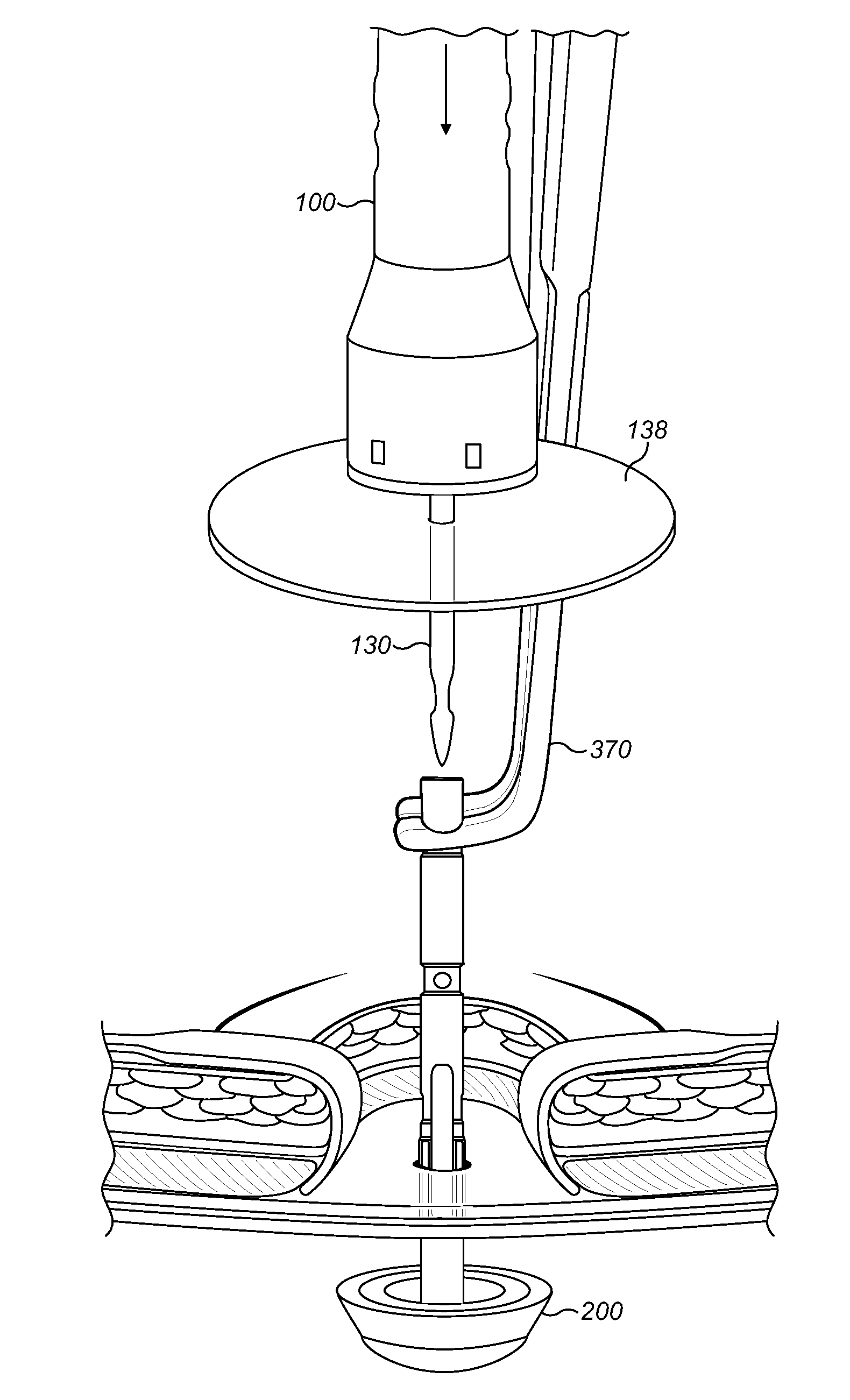 Method And Apparatus For Forming Stoma Trephines And Anastomoses