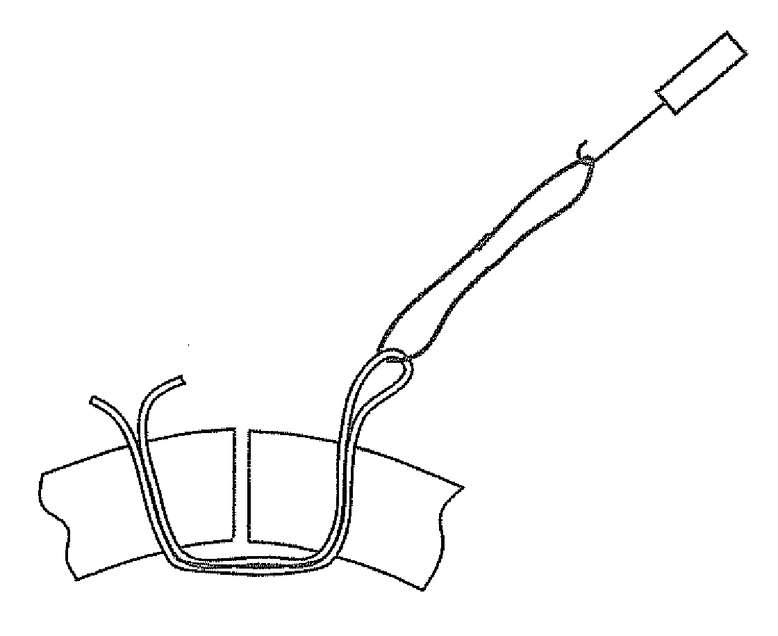 Soft tissue repair methods and apparatus