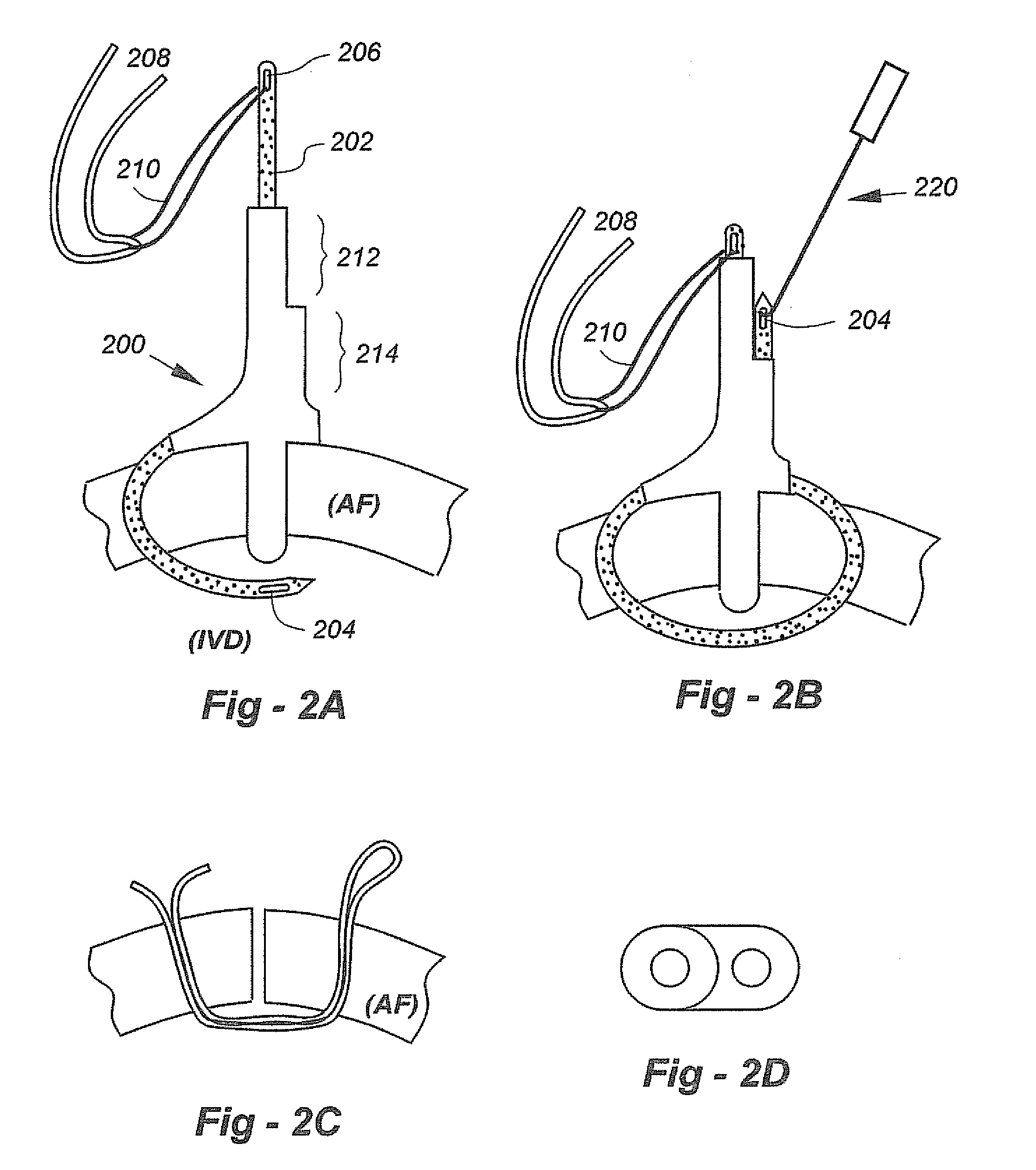 Soft tissue repair methods and apparatus