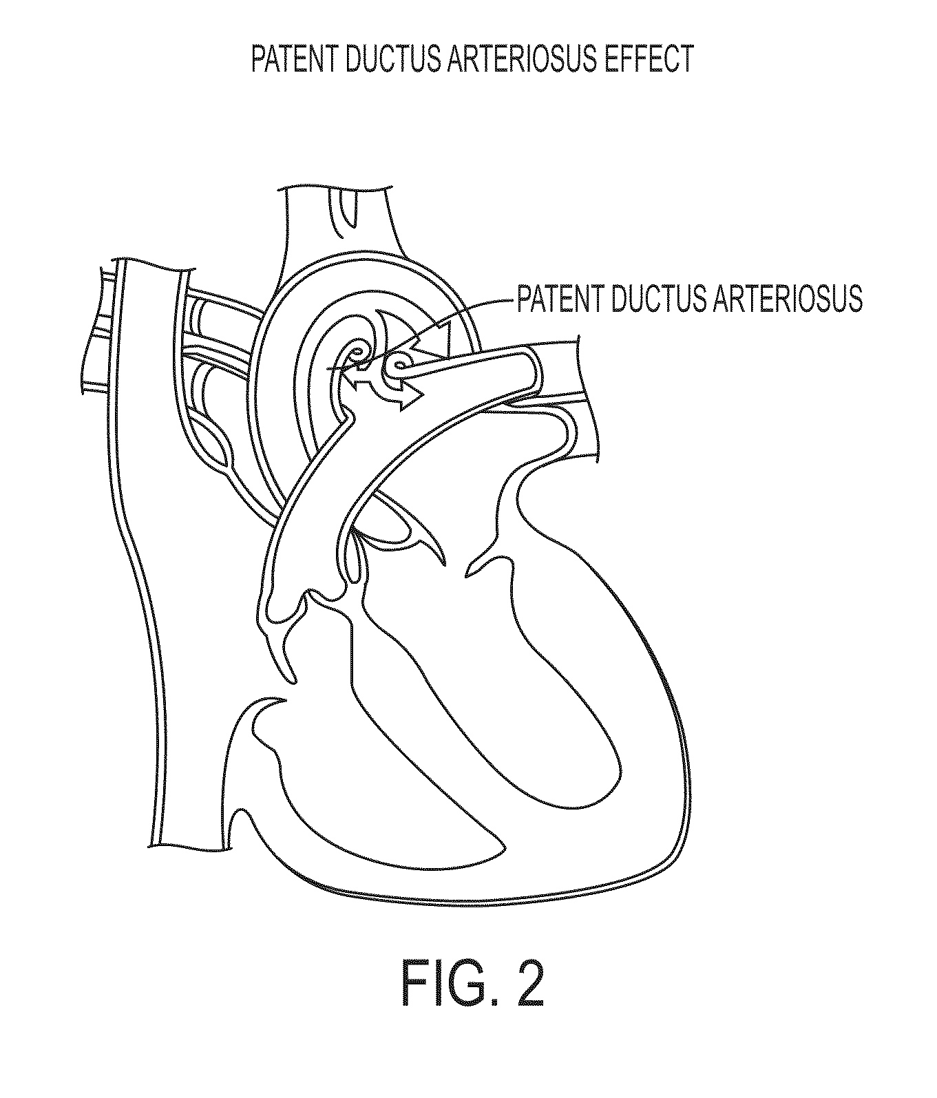 Method for intrathecal administration of autologous stem cells in premature infants