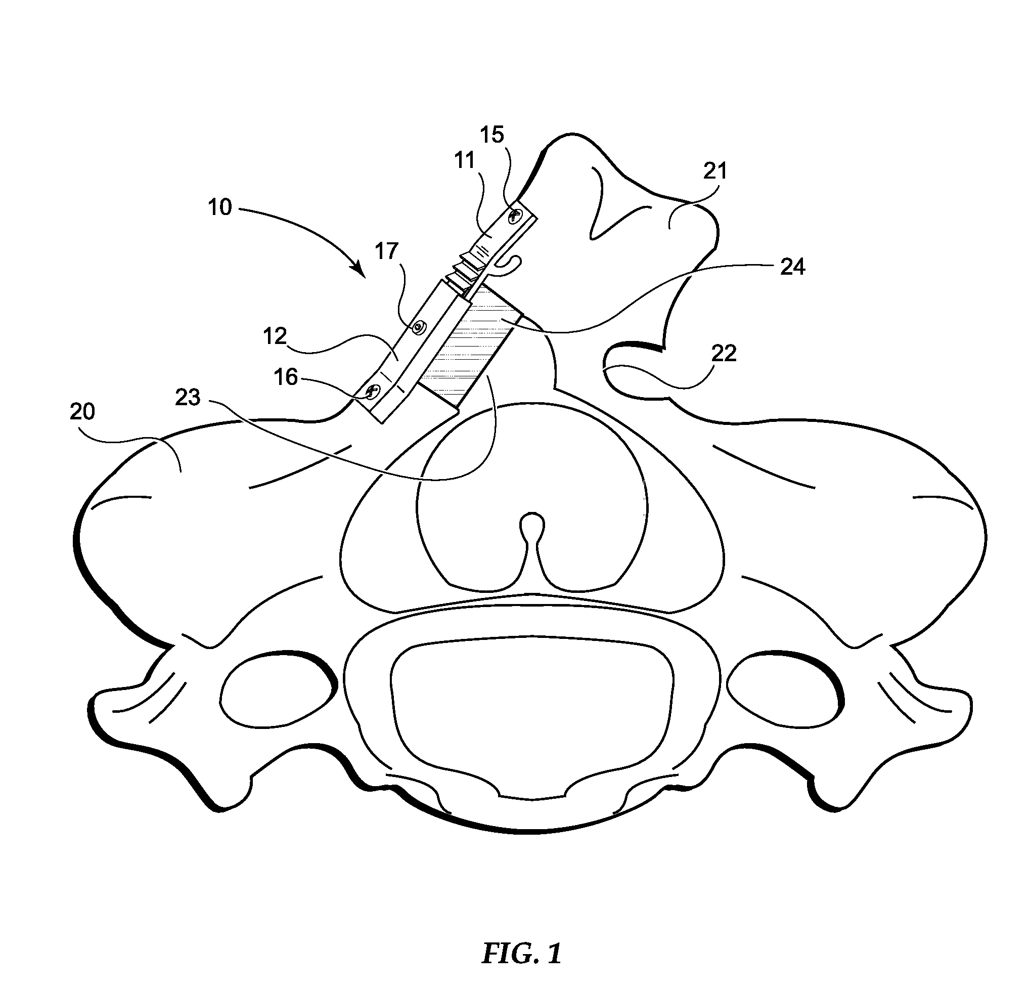 Expandable Laminoplasty Fixation System