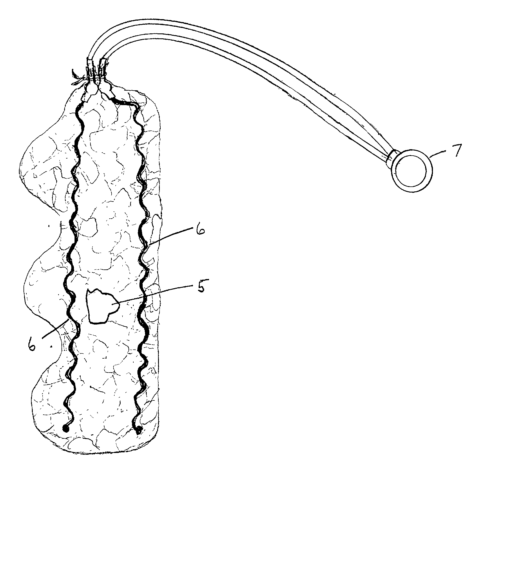 Bone graft and implantable fusion stimulator positioning device