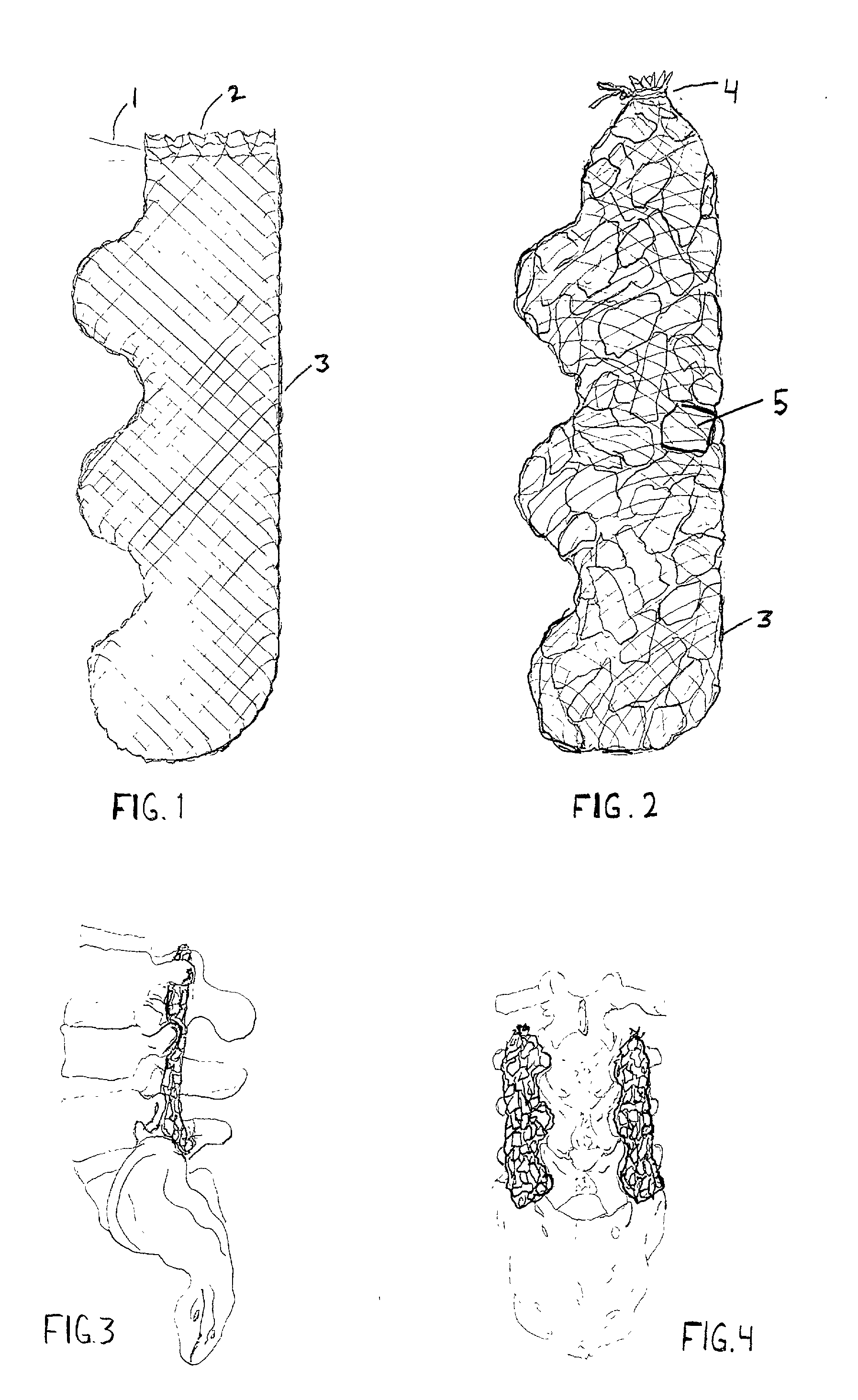 Bone graft and implantable fusion stimulator positioning device