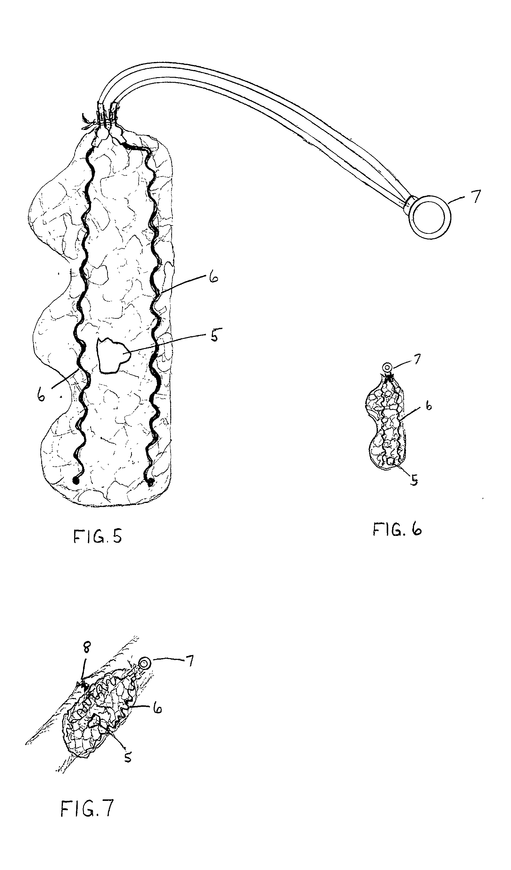 Bone graft and implantable fusion stimulator positioning device