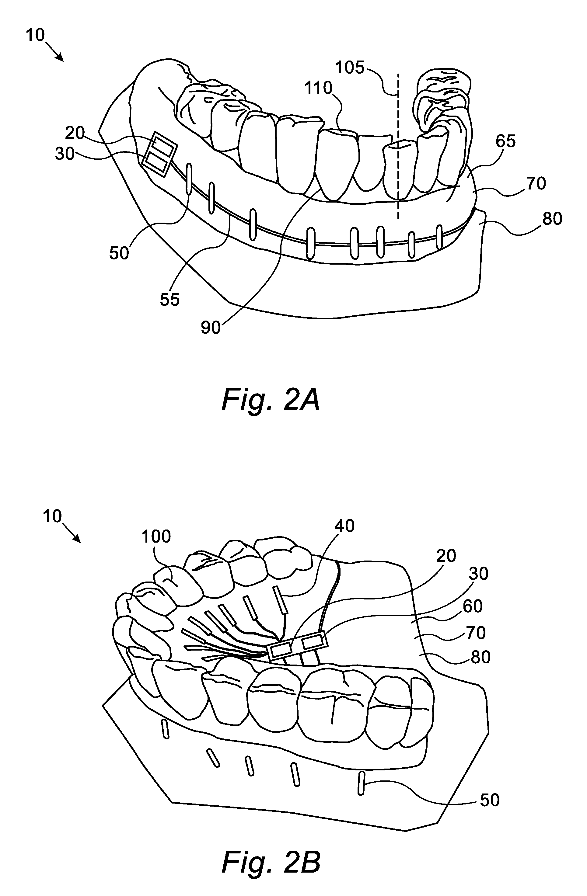 Vestibular electronic orthodontic appliance expediter and method