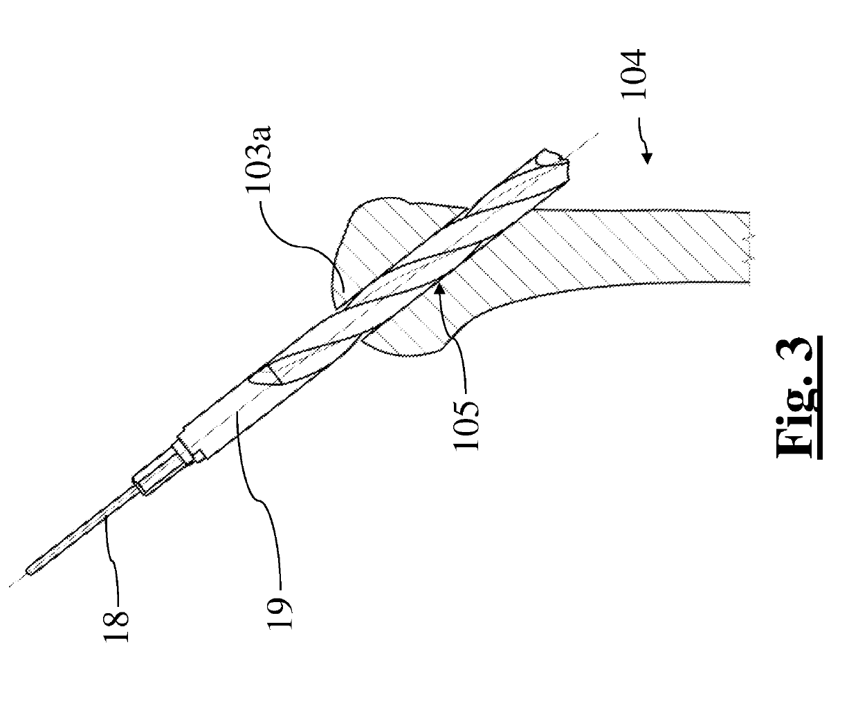 Method for surgical application of a glenoid prosthesis component of a shoulder joint prosthesis and relating surgical instruments