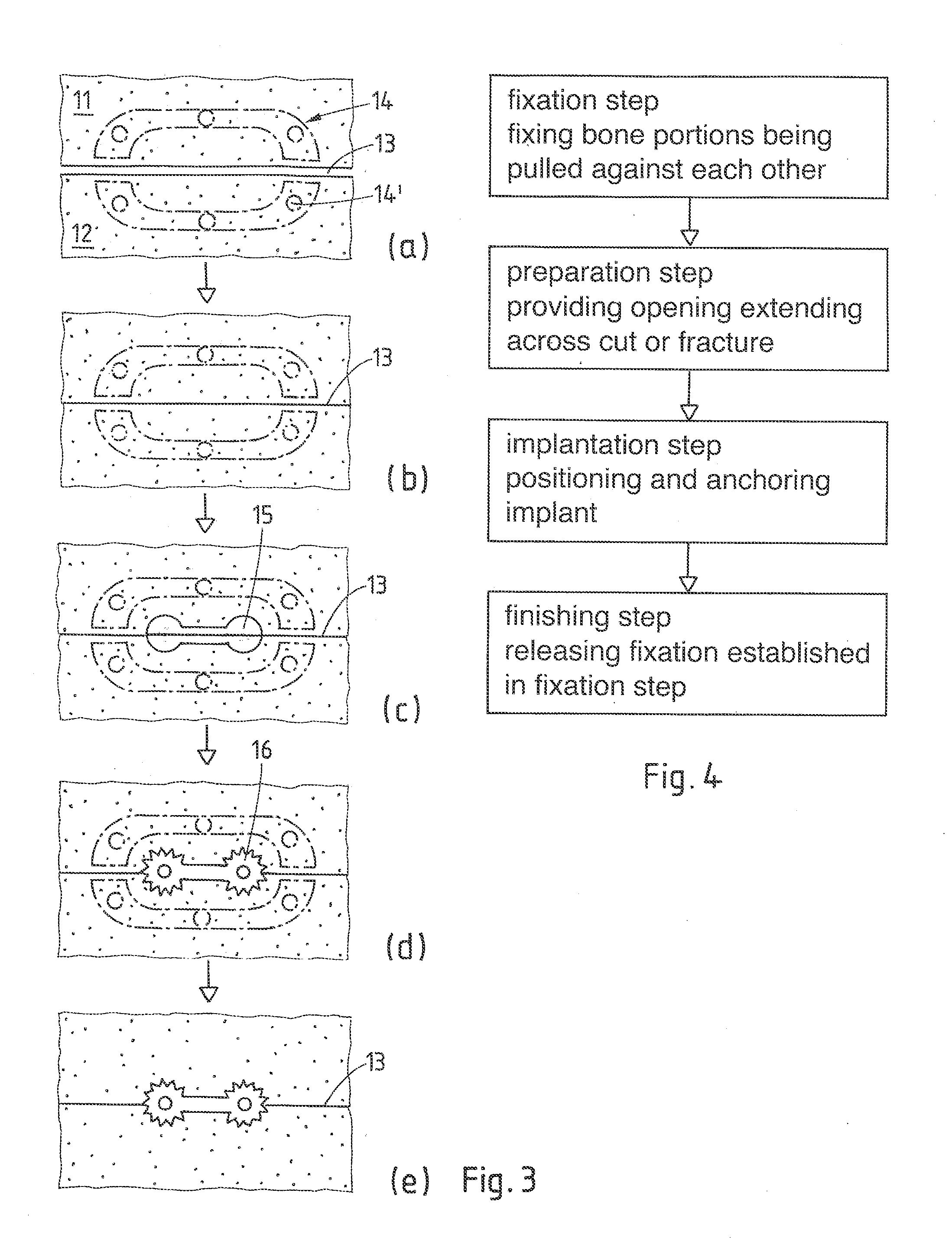 Method and implant for stabilizing two bone portions separated by a cut or fracture