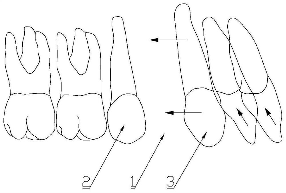 Invisible appliance capable of preventing toppling during tooth extraction