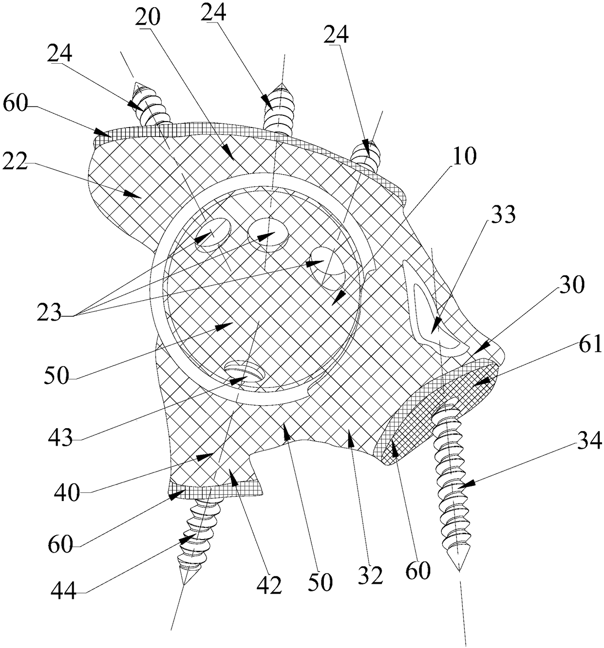 Prosthetic structures around the acetabulum