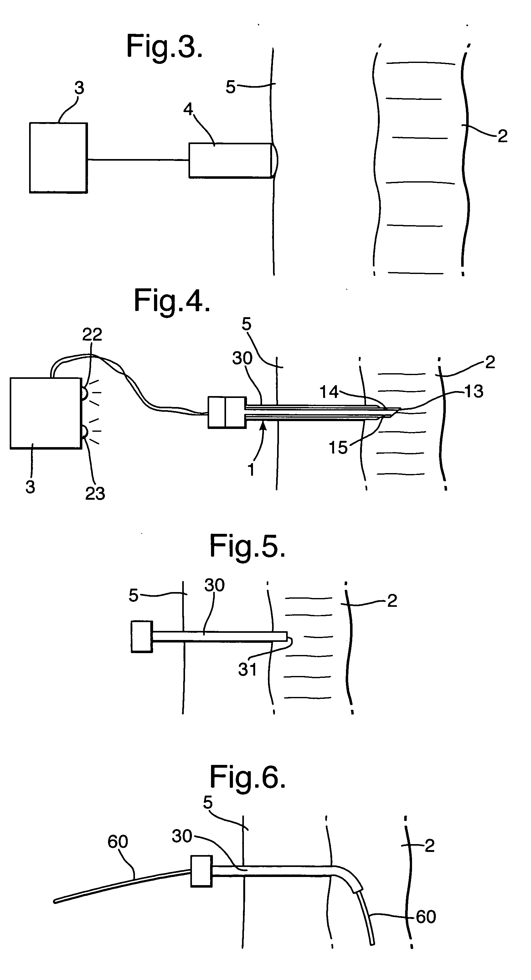 Tracheostomy apparatus