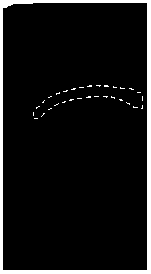 A method and system for suppressing skeletal shadows in digital chest X-ray images