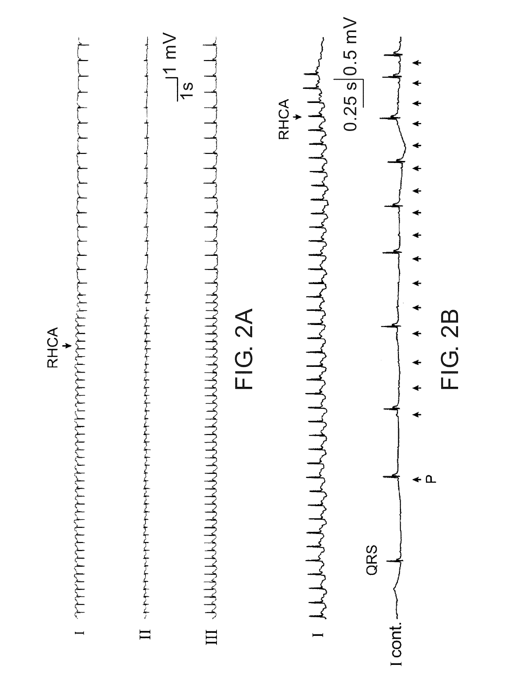 Methods and implantable devices for treating supraventricular arrhythmias