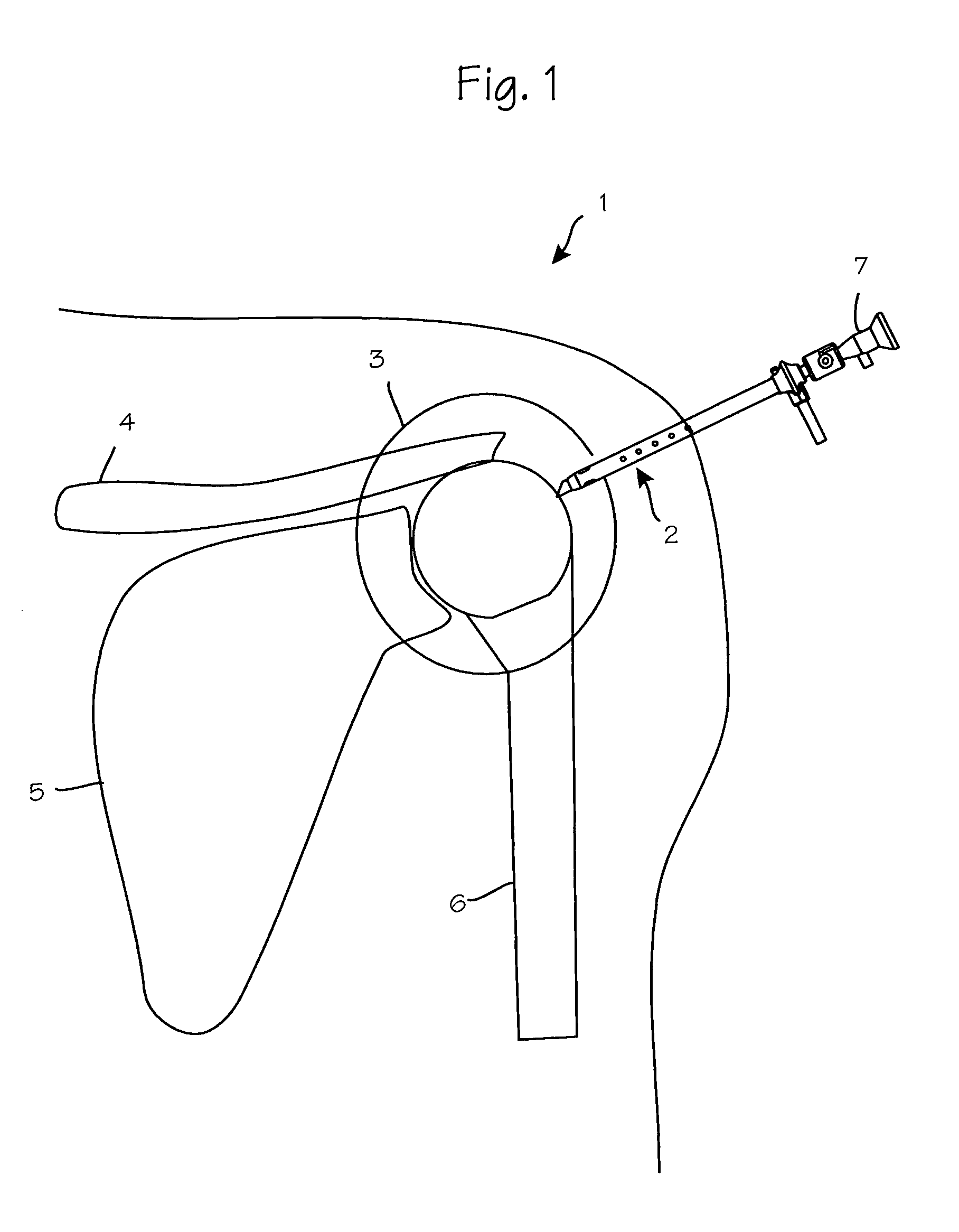 Anti-extravasation sheath and method