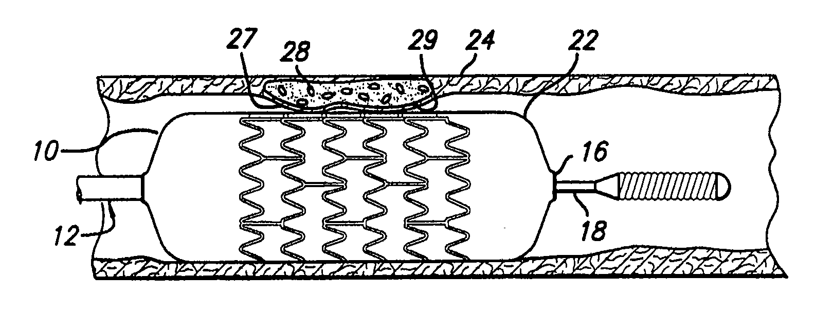 Stent with anchors to prevent vulnerable plaque rupture during deployment