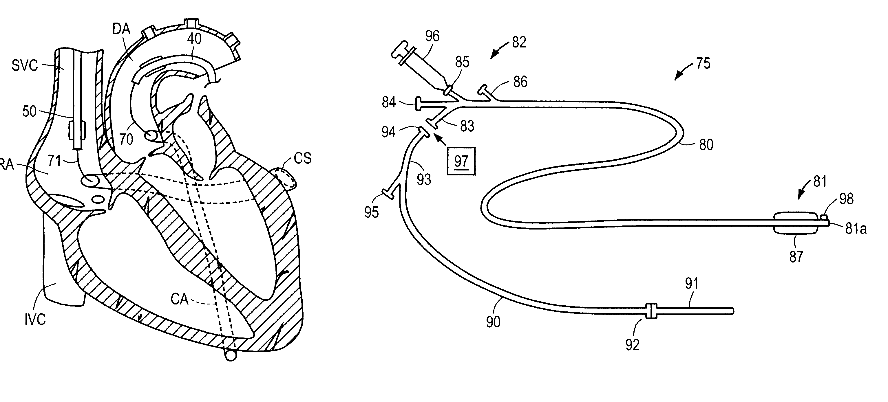 Methods and apparatus for treating infarcted regions of tissue following acute myocardial infarction