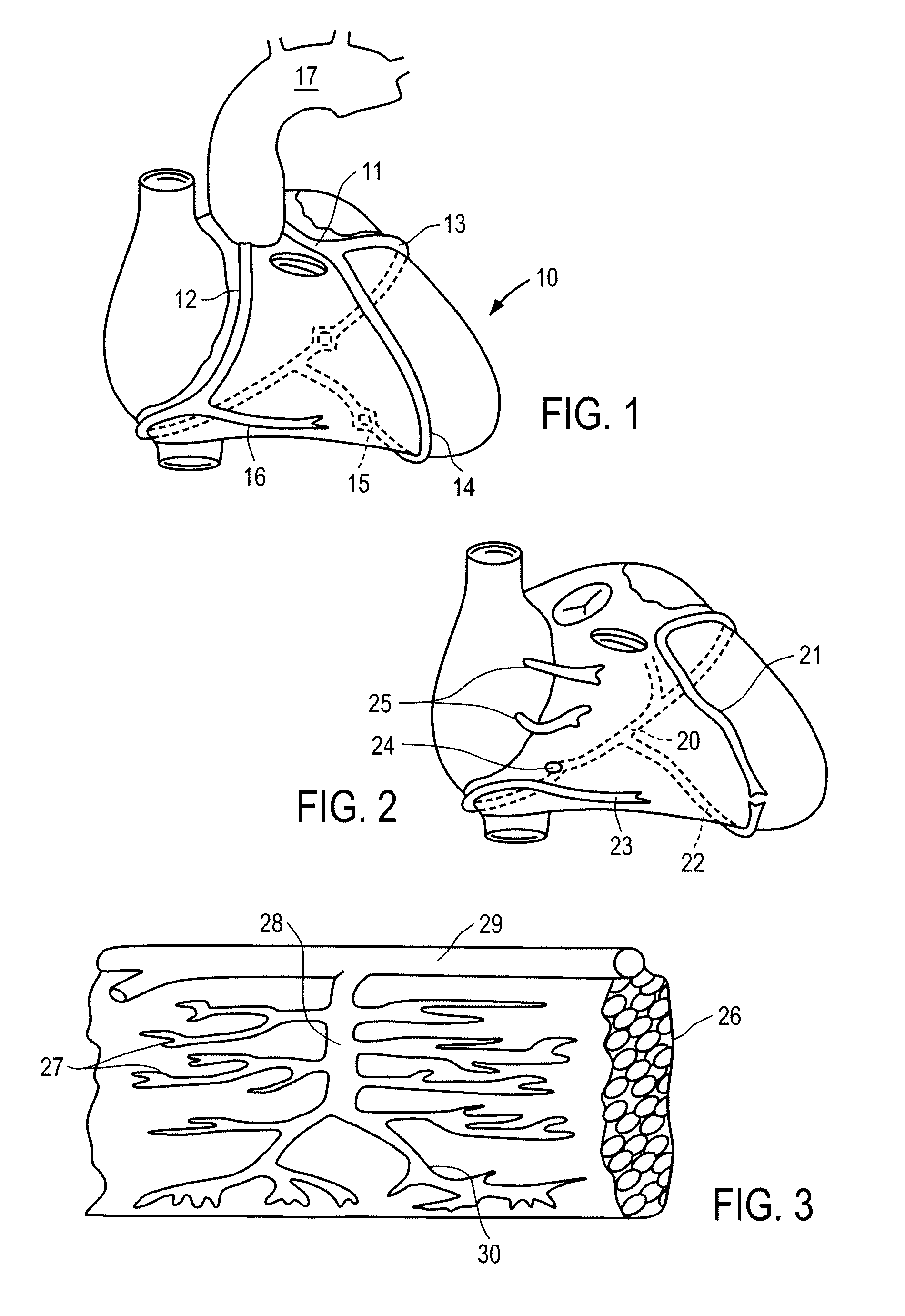 Methods and apparatus for treating infarcted regions of tissue following acute myocardial infarction